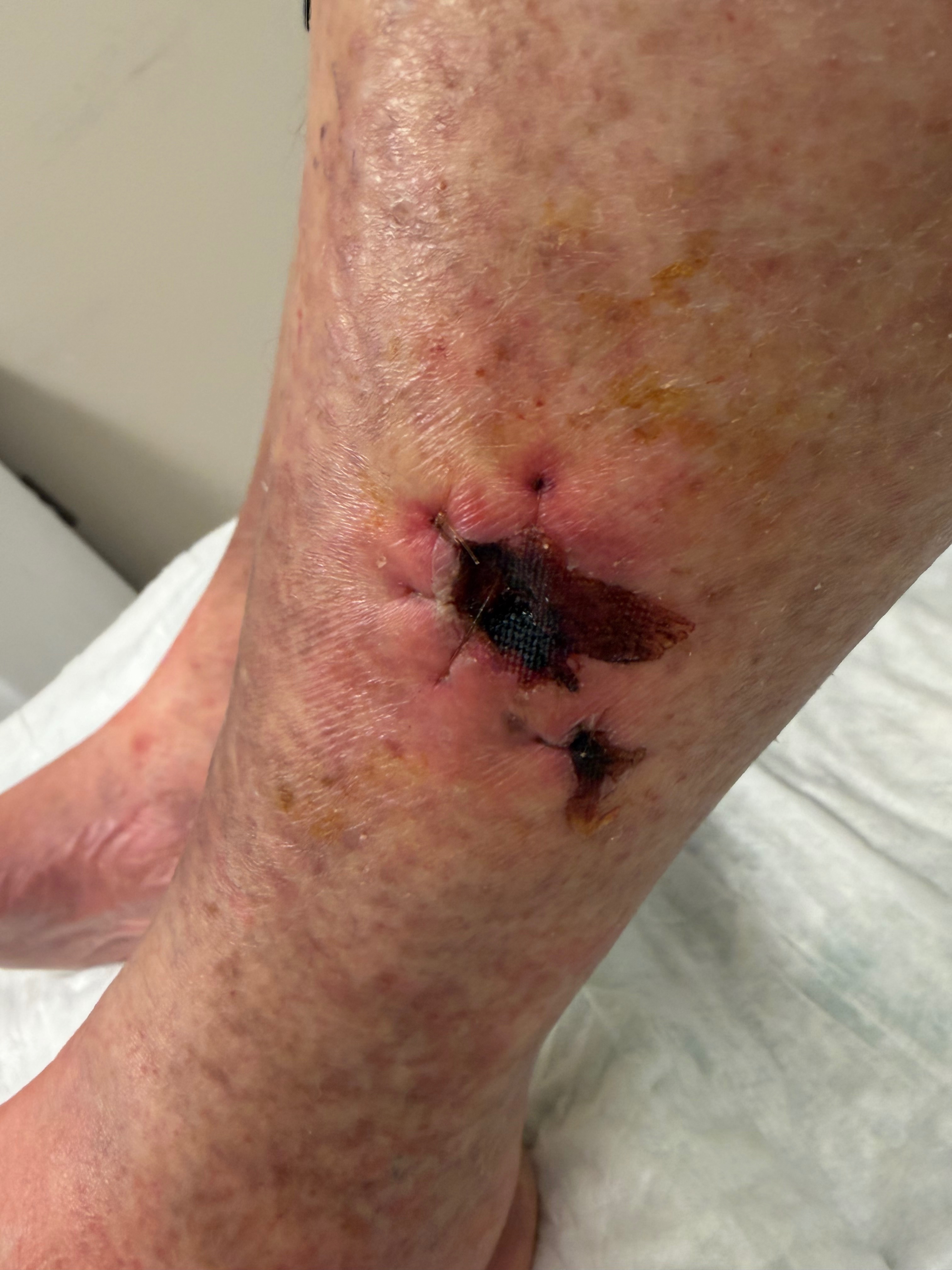 Help Susseth Fight Calciphylaxis campaign photo, 7 of 8