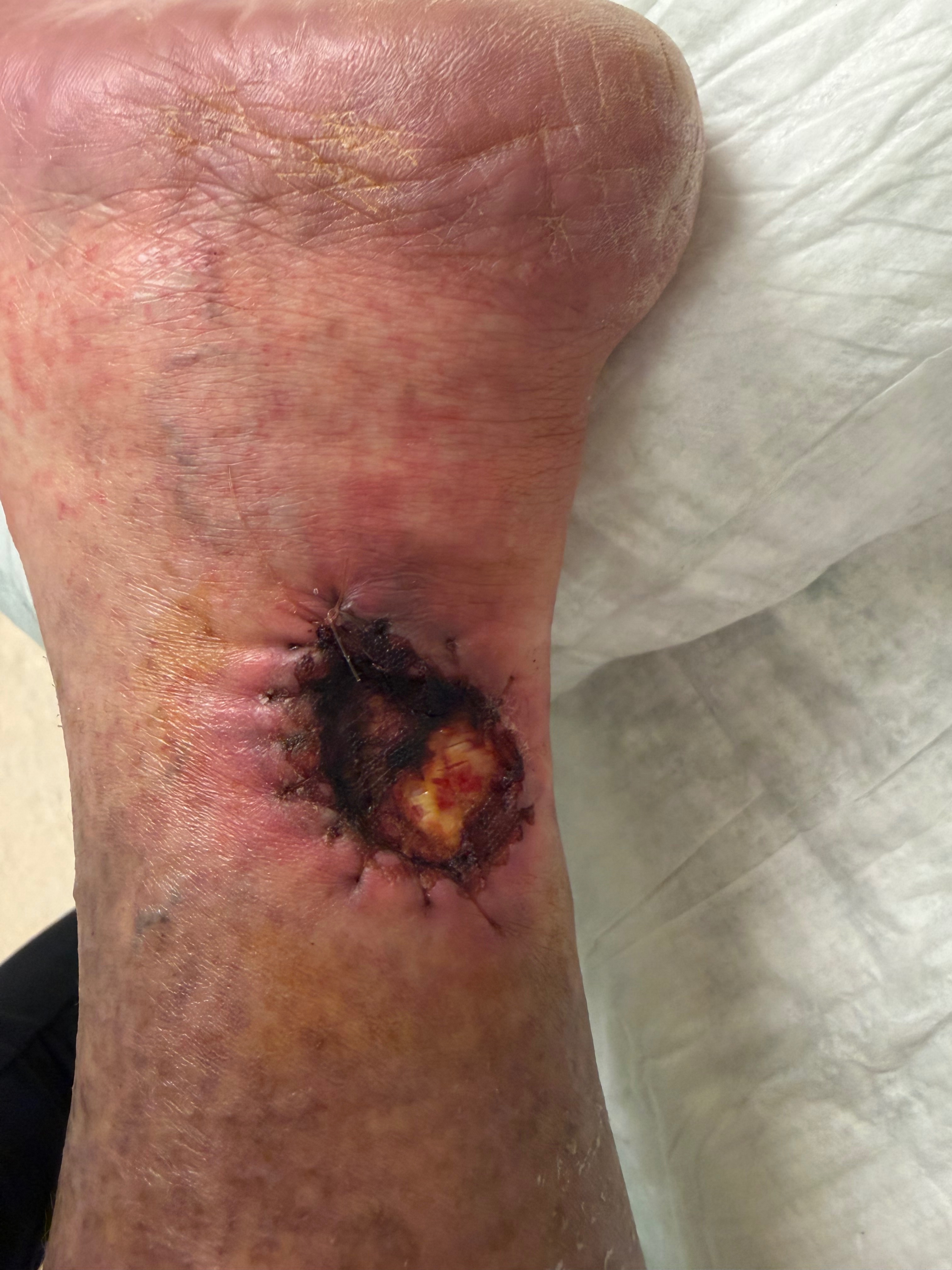 Help Susseth Fight Calciphylaxis campaign photo, 2 of 8