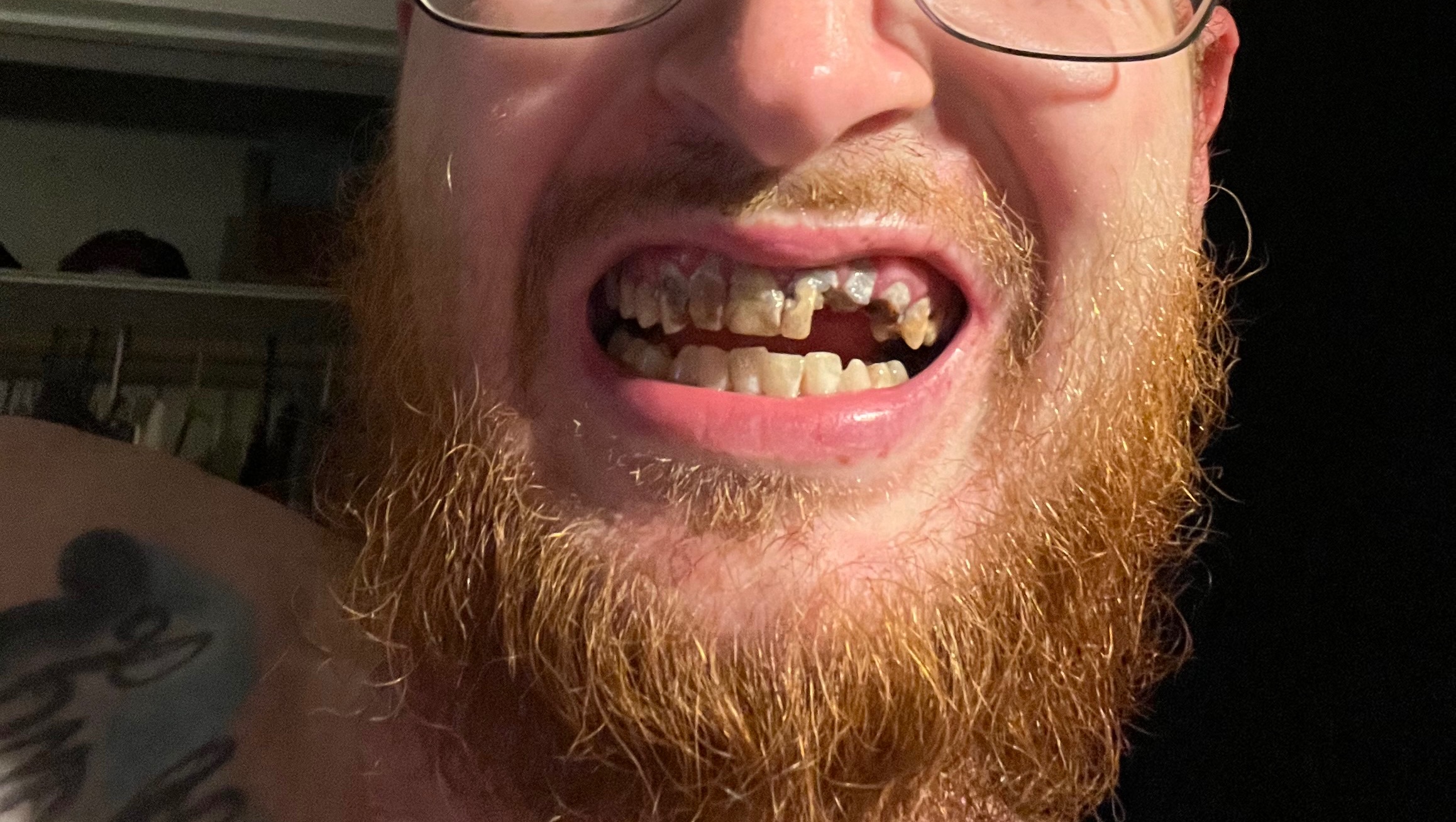 Help Me Get Dental Implants photo