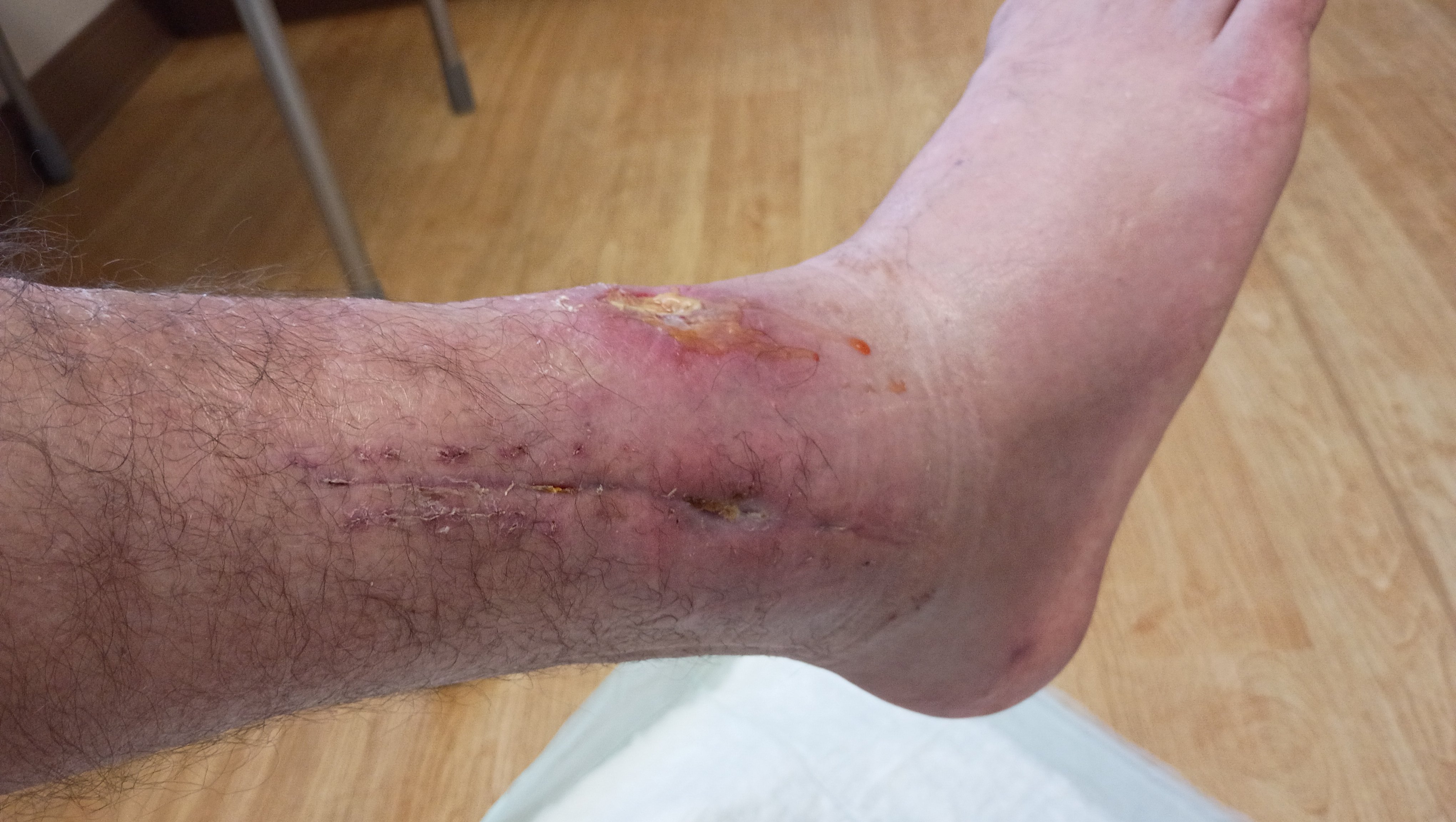 Help Daniel Recover After Scooter Accident photo