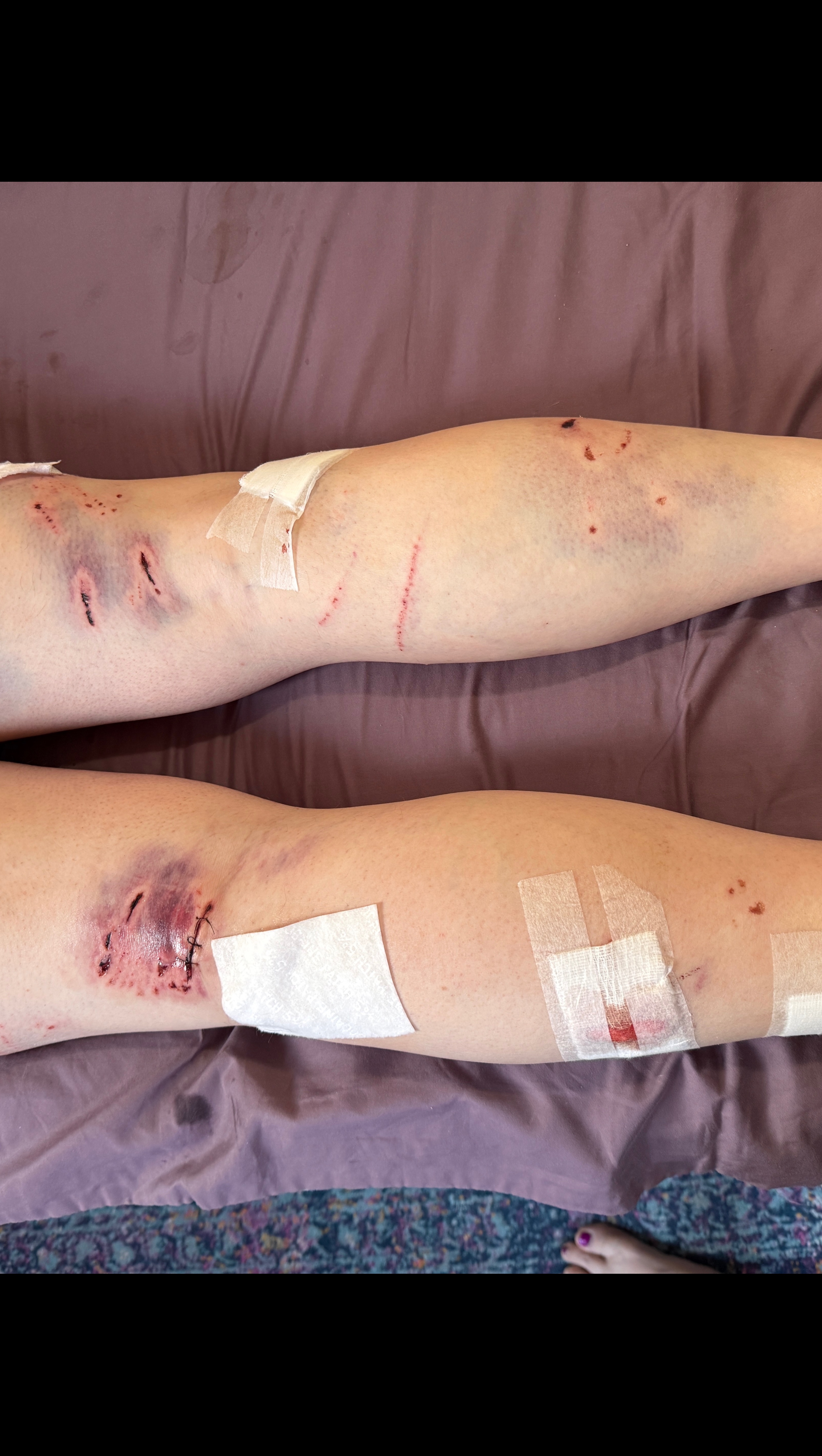 Support After Dog Attack (or maybe Velociraptors!) photo
