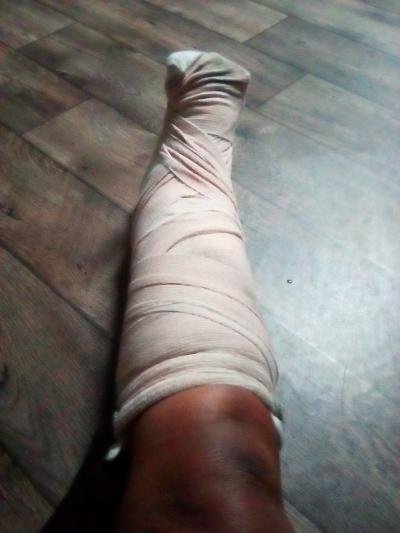 Help Vonnie Recover After Ankle Surgery campaign photo, 2 of 8