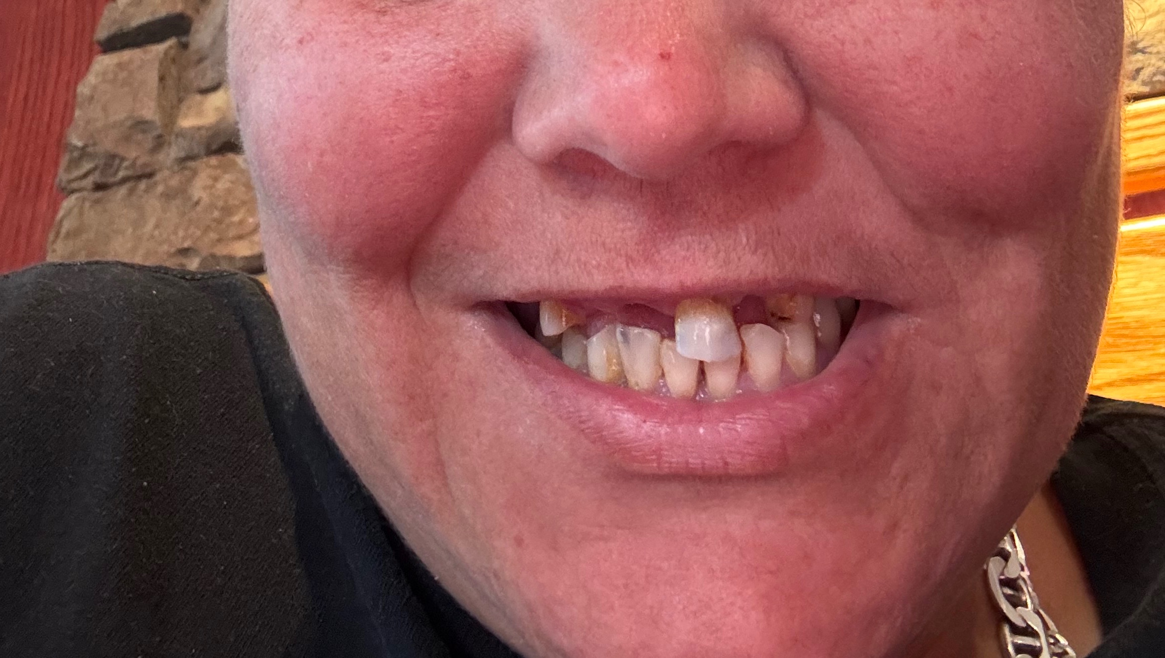 Help Me Get Dentures and Restore My Smile photo