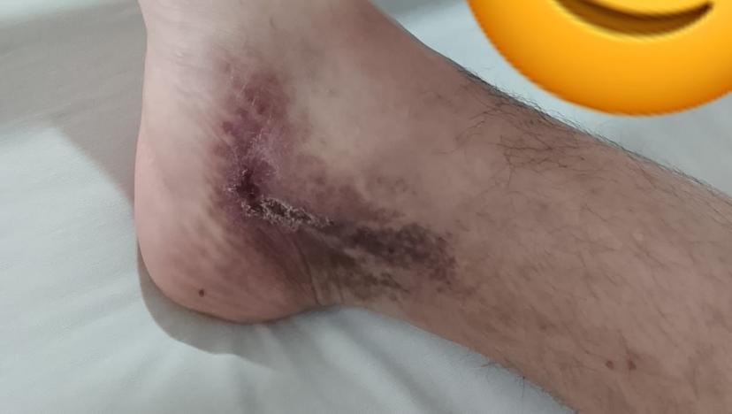 Ayuda para cirugía trombectomia en pierna derecha photo
