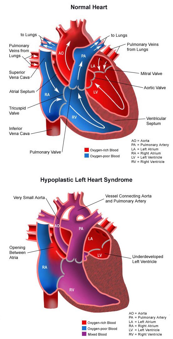 Help Angel Fight Hypoplastic Left Heart Syndrome campaign photo, 10 of 11