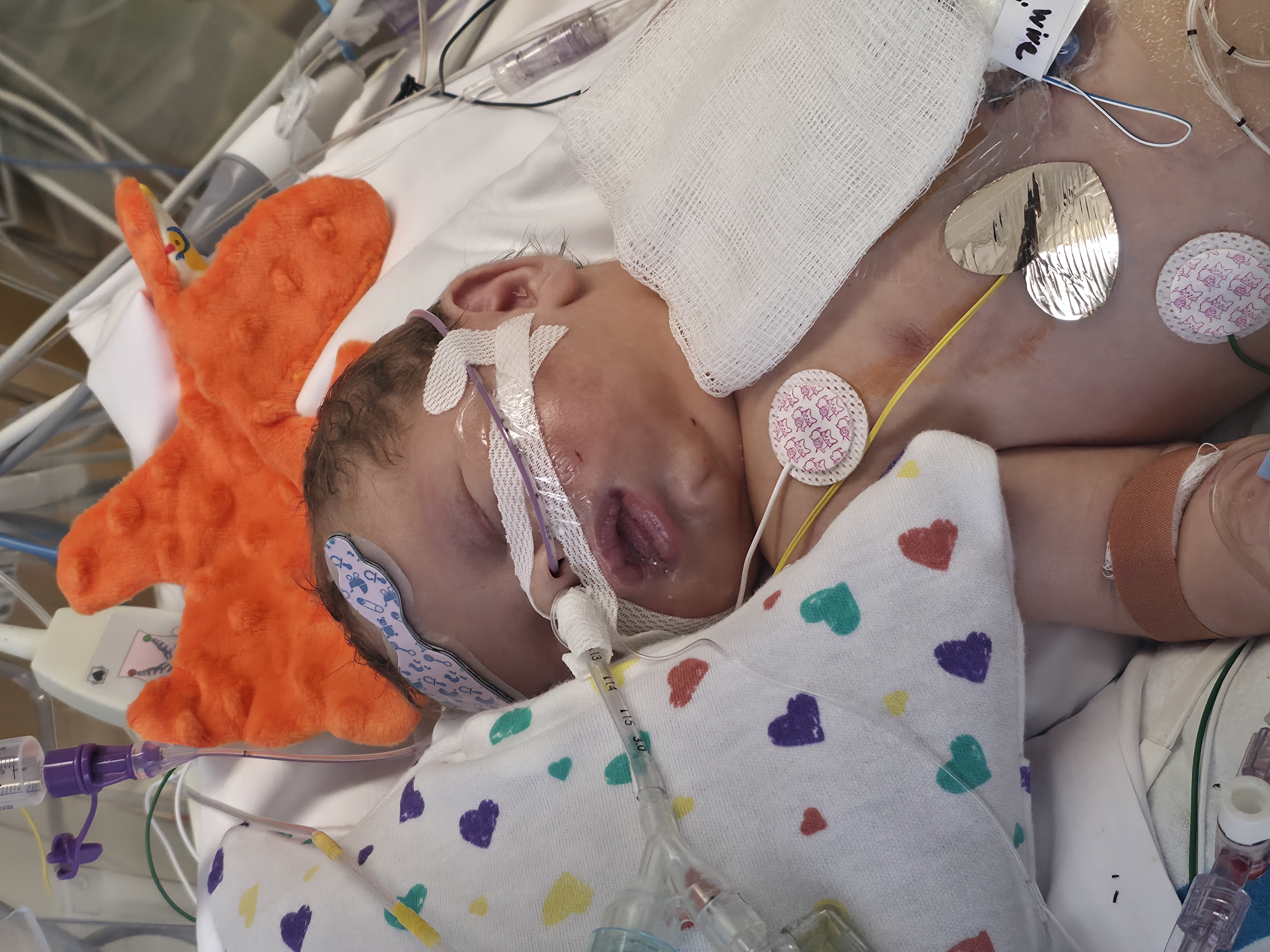 Help Angel Fight Hypoplastic Left Heart Syndrome campaign photo, 5 of 11