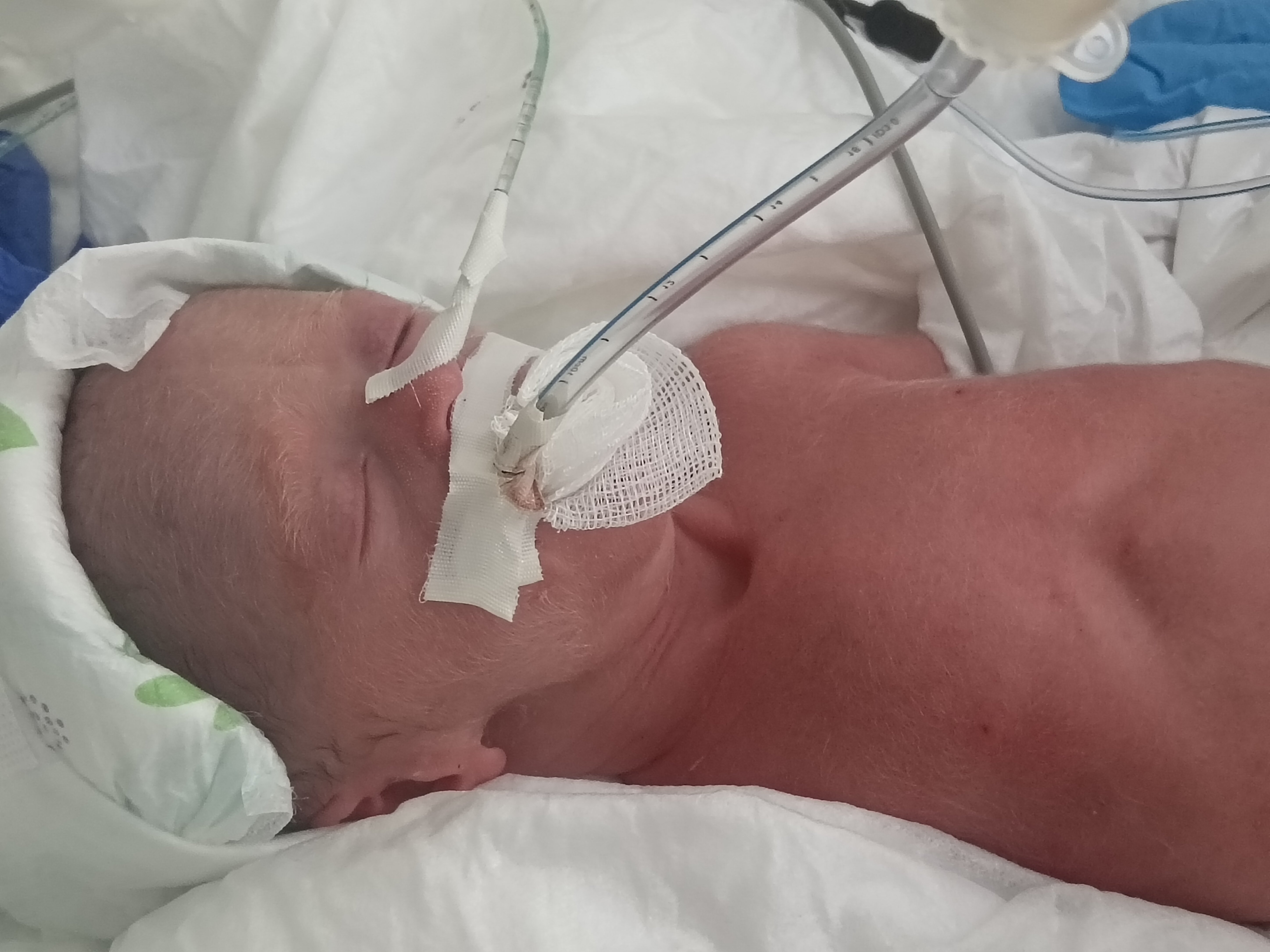 Help Micro-Preemie Alyssia Fight For Her Life in NICU campaign photo, 2 of 8
