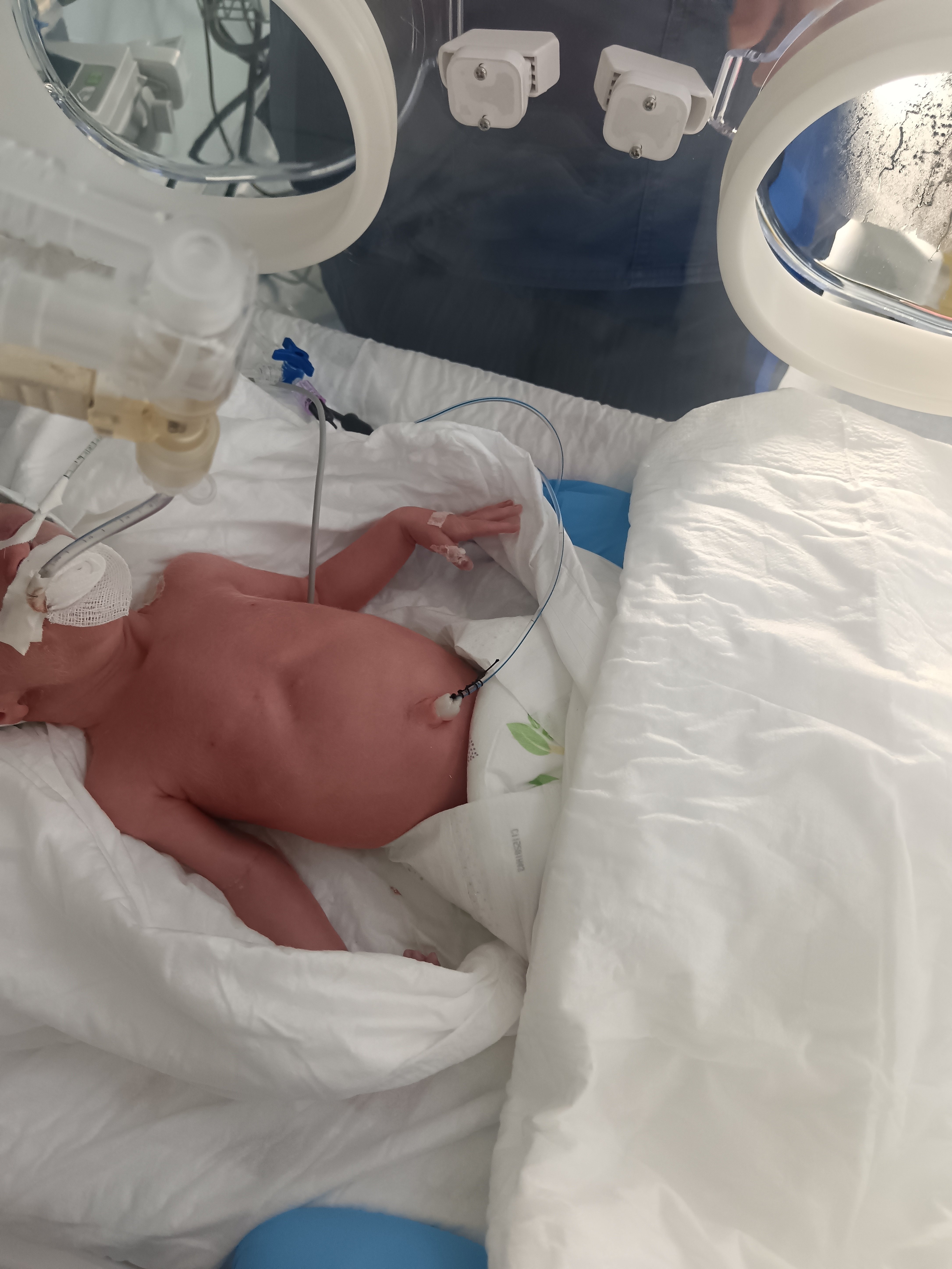 Help Micro-Preemie Alyssia Fight For Her Life in NICU campaign photo, 5 of 8