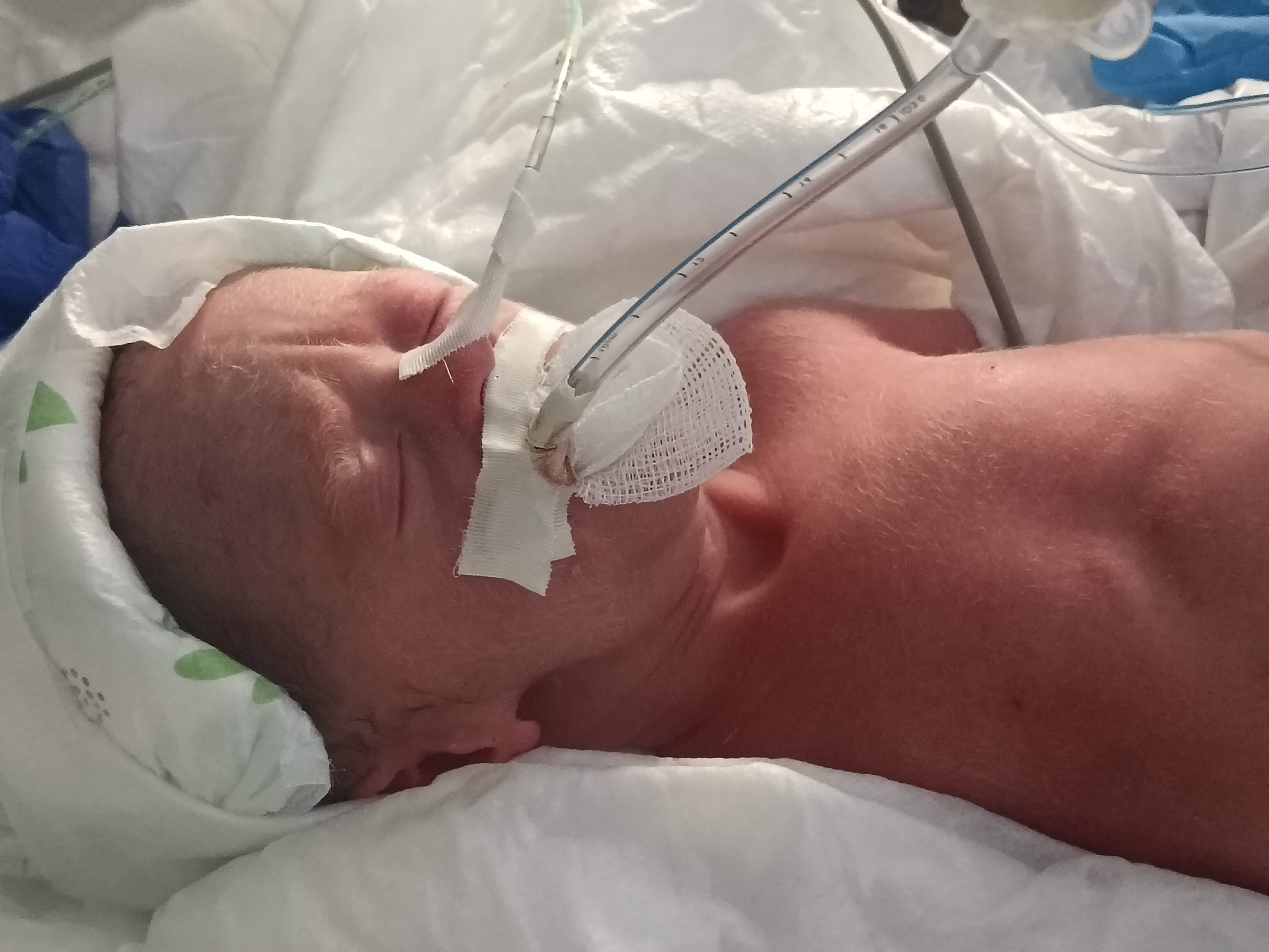 Help Micro-Preemie Alyssia Fight For Her Life in NICU campaign photo, 4 of 8