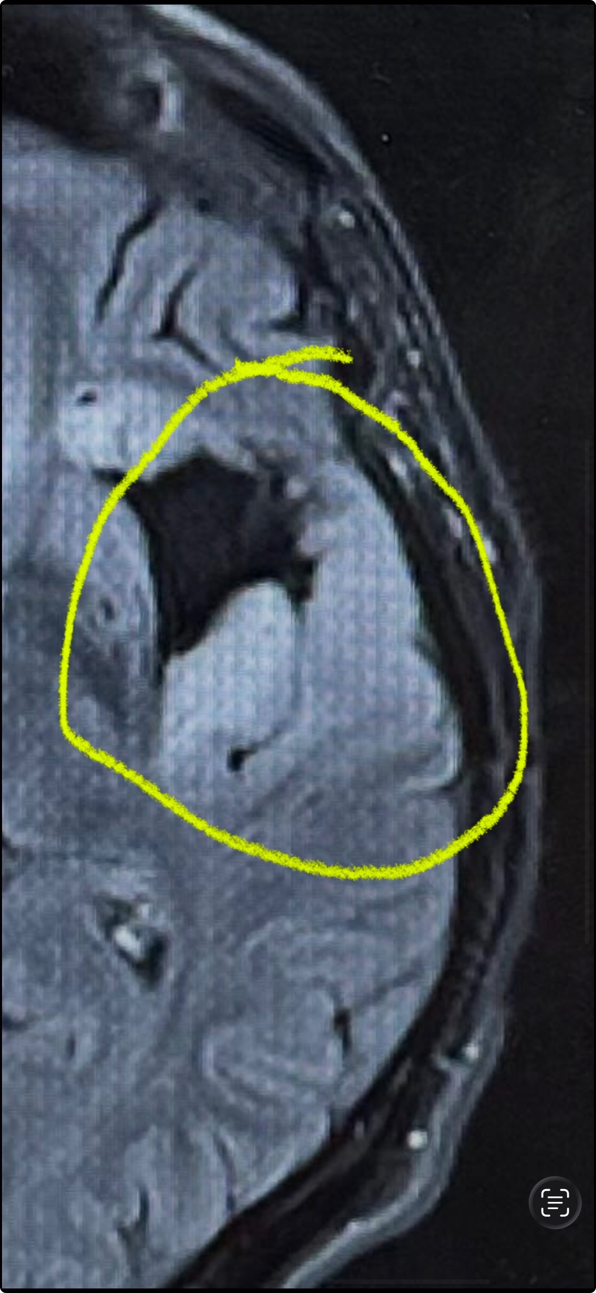 Stephen Rezza My Second Brain Surgery campaign photo, 2 of 8