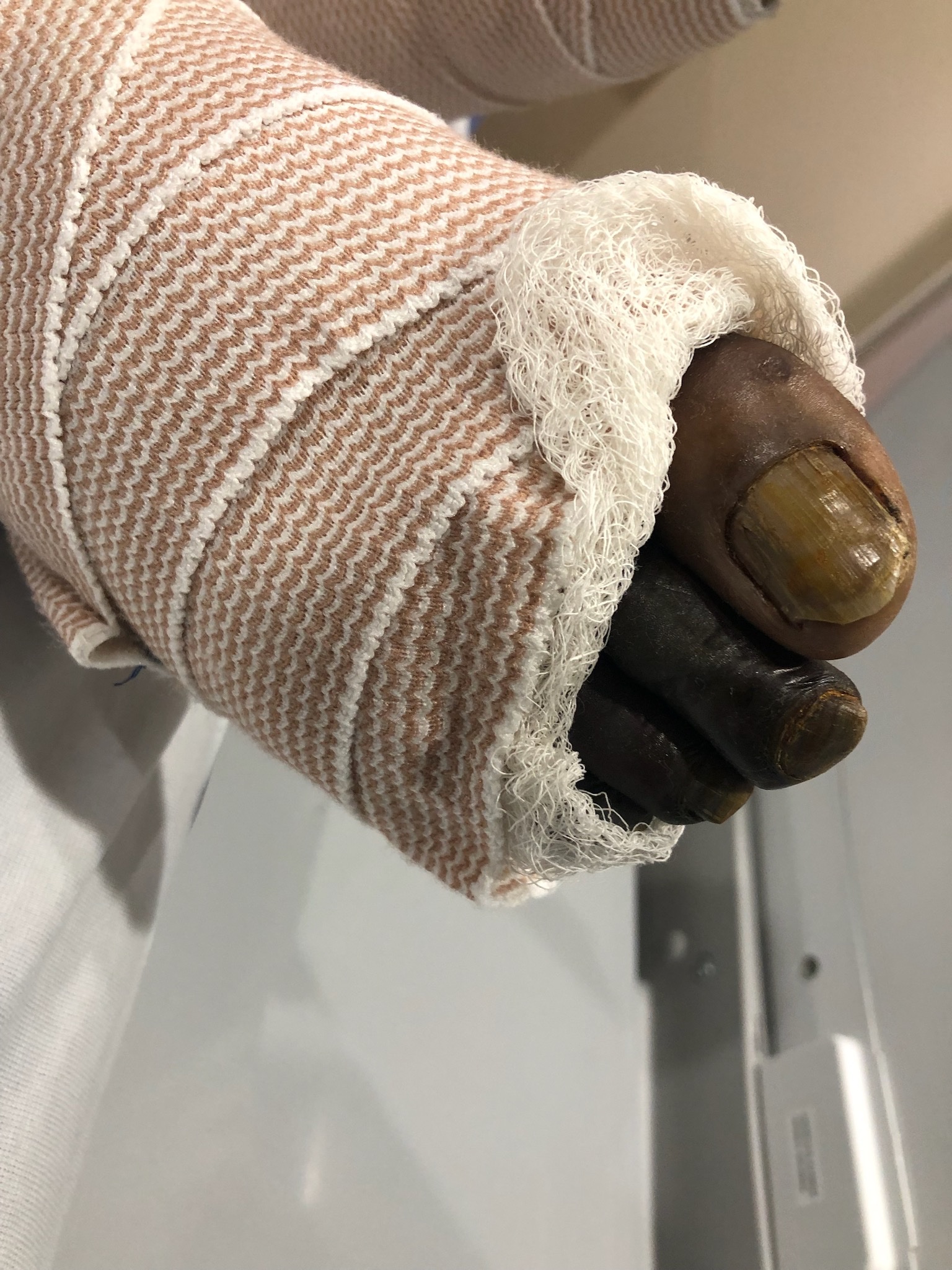 Help Mark Rebuild After Dog Bite & Amputation campaign photo, 2 of 8