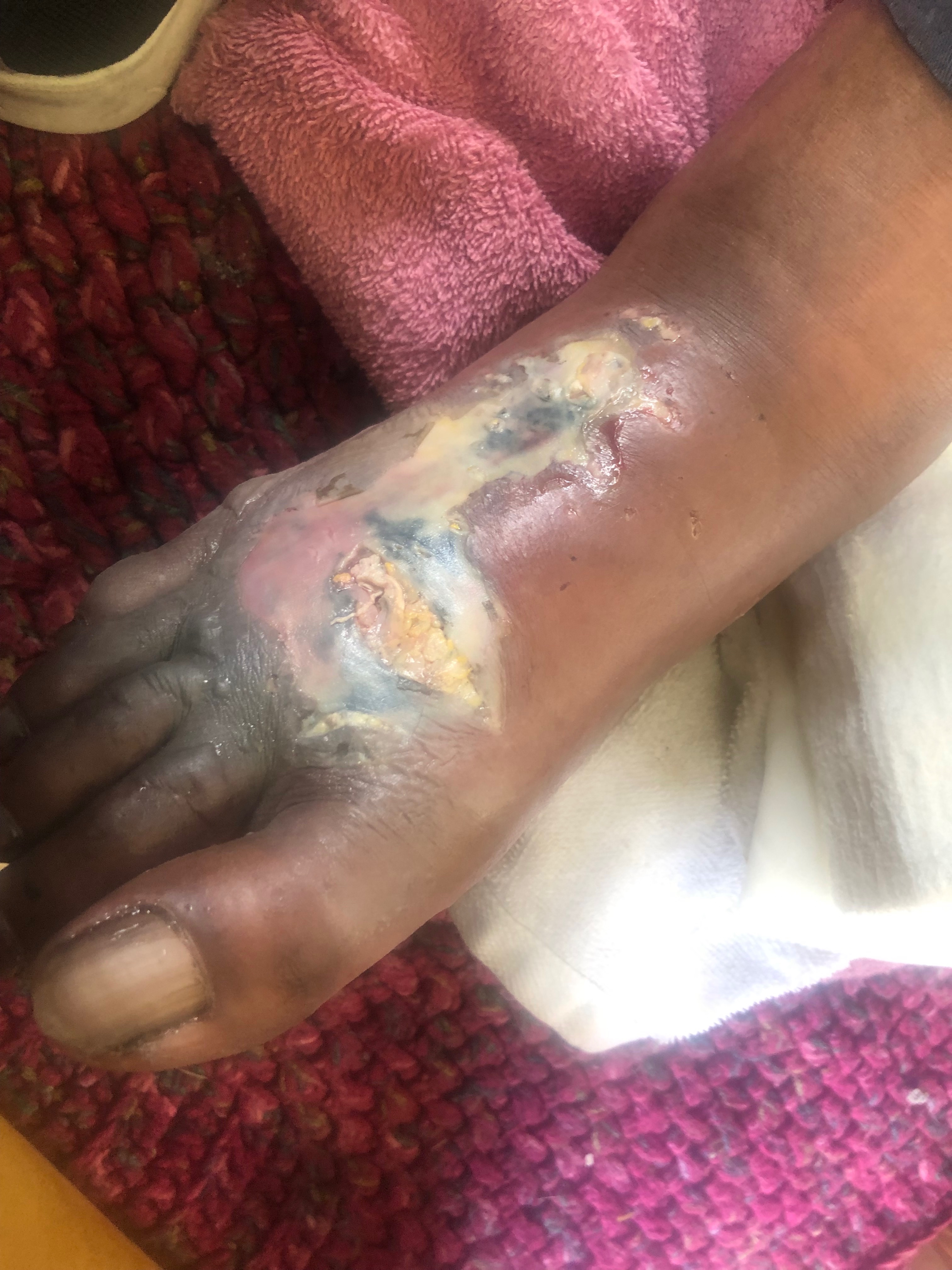 Help Mark Rebuild After Dog Bite & Amputation campaign photo, 4 of 8