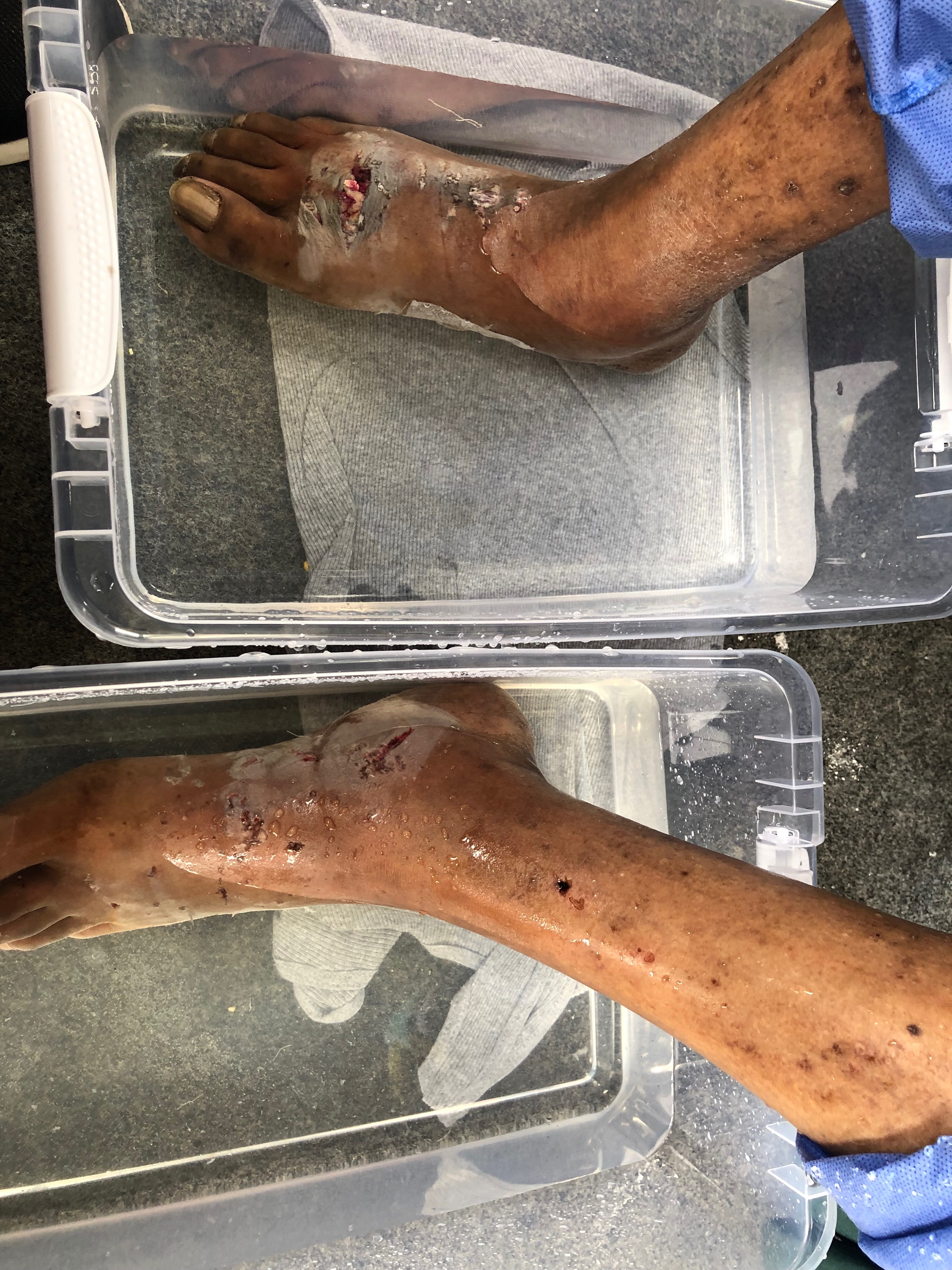 Help Mark Rebuild After Dog Bite & Amputation campaign photo, 5 of 8