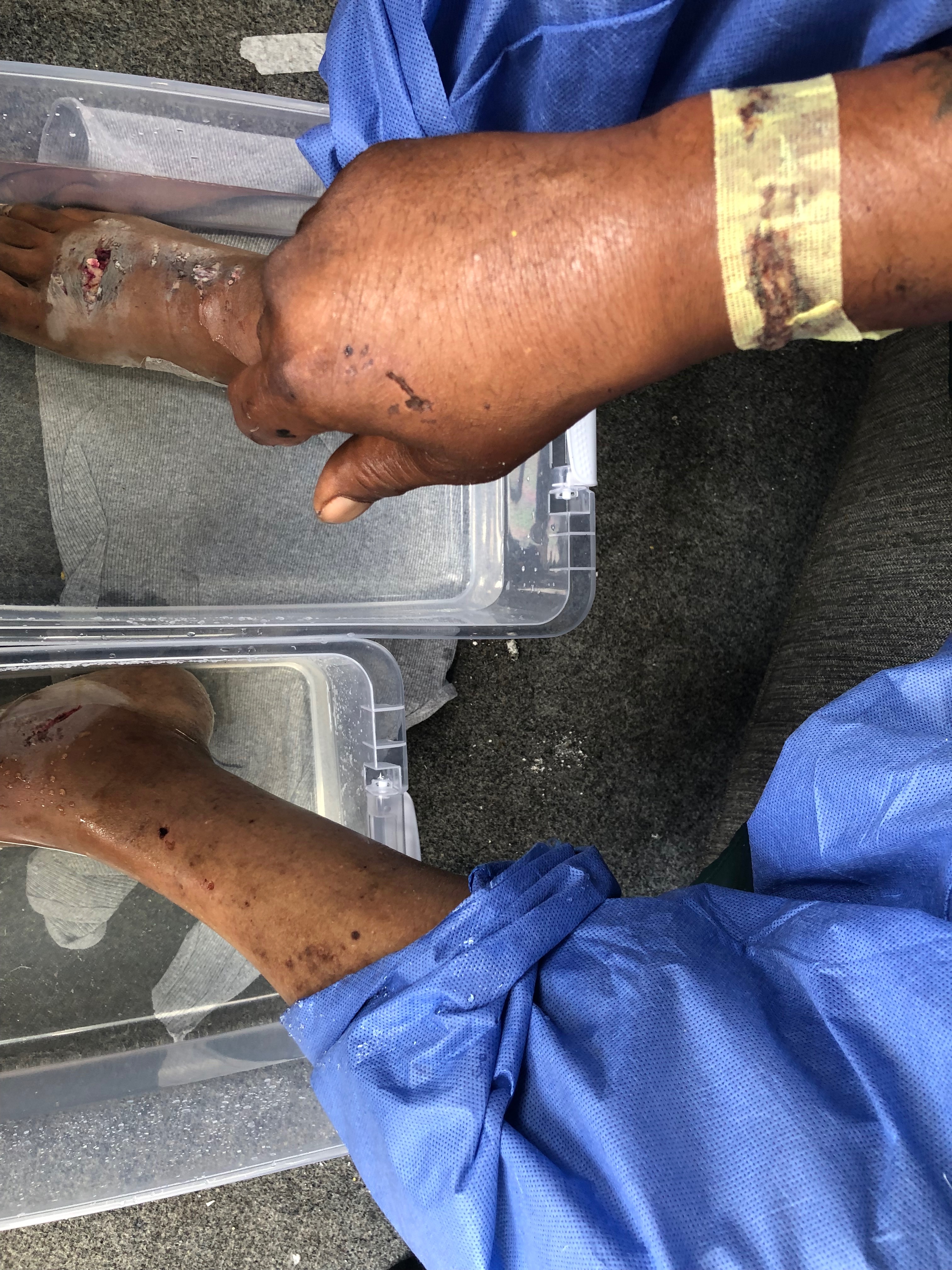 Help Mark Rebuild After Dog Bite & Amputation campaign photo, 6 of 8