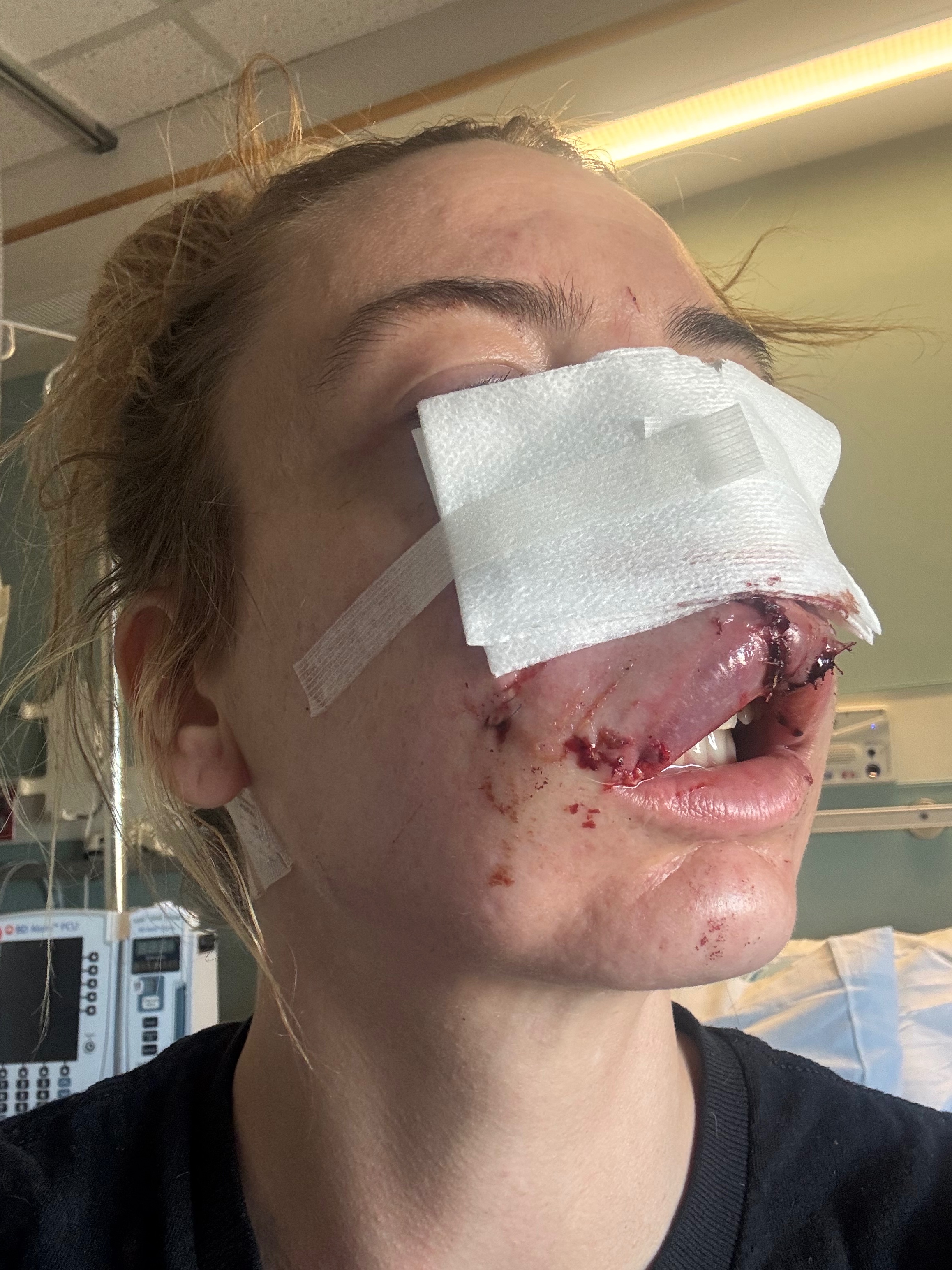 Support Heather's Healing After Dog Attack campaign photo, 5 of 8