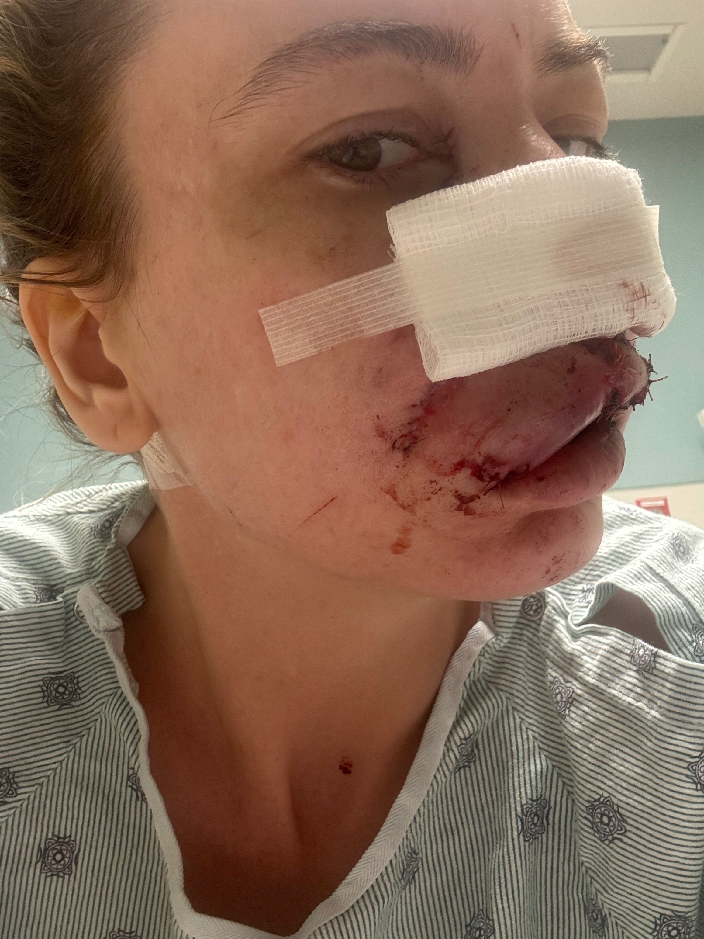 Support Heather's Healing After Dog Attack campaign photo, 6 of 8