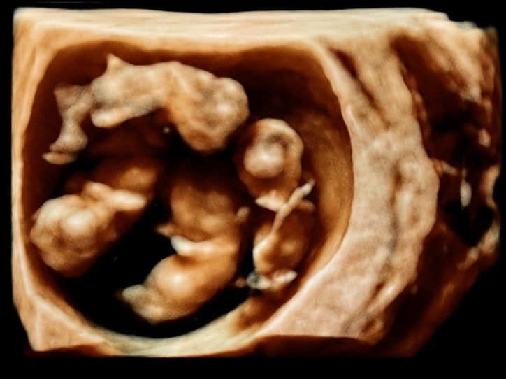 AS RARE AS 1 IN 15-64 MILLION, OUR IDENTICAL QUADS ARE HERE! campaign photo, 5 of 6