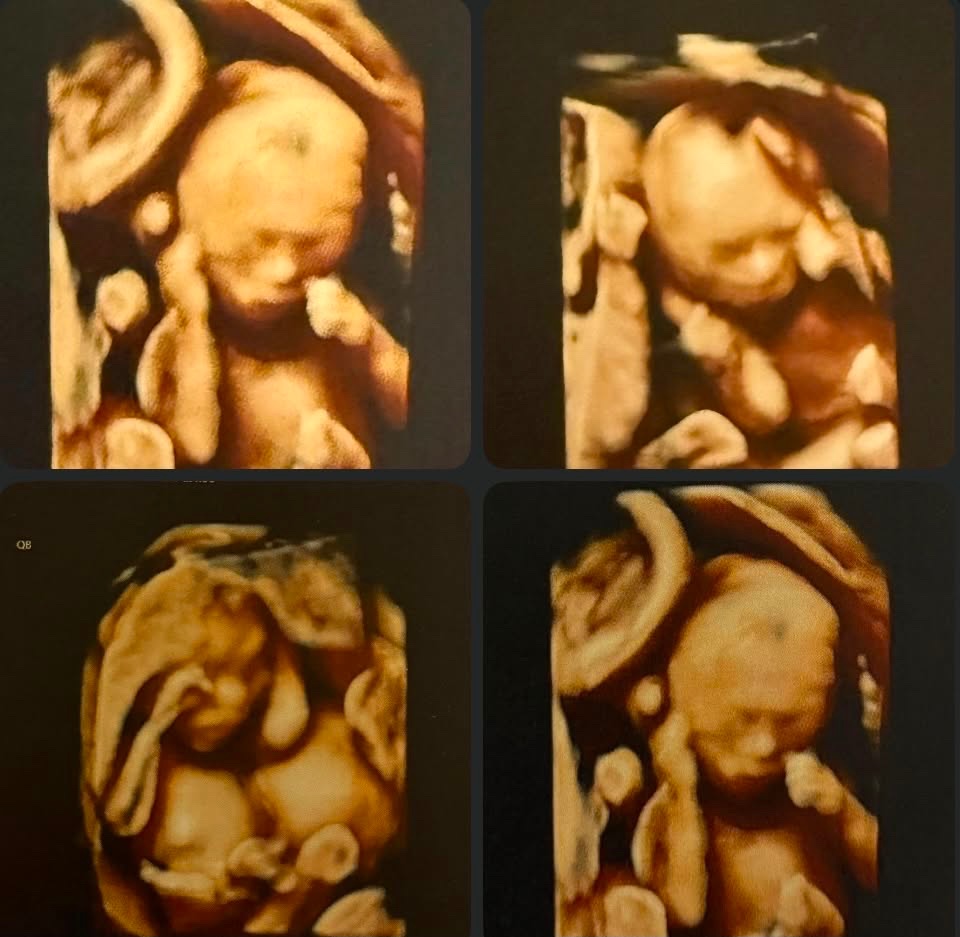 AS RARE AS 1 IN 15-64 MILLION, OUR IDENTICAL QUADS ARE HERE! campaign photo, 2 of 6