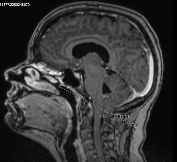 Support Tiffany's Brain Decompression Surgery & Recovery campaign photo, 4 of 5