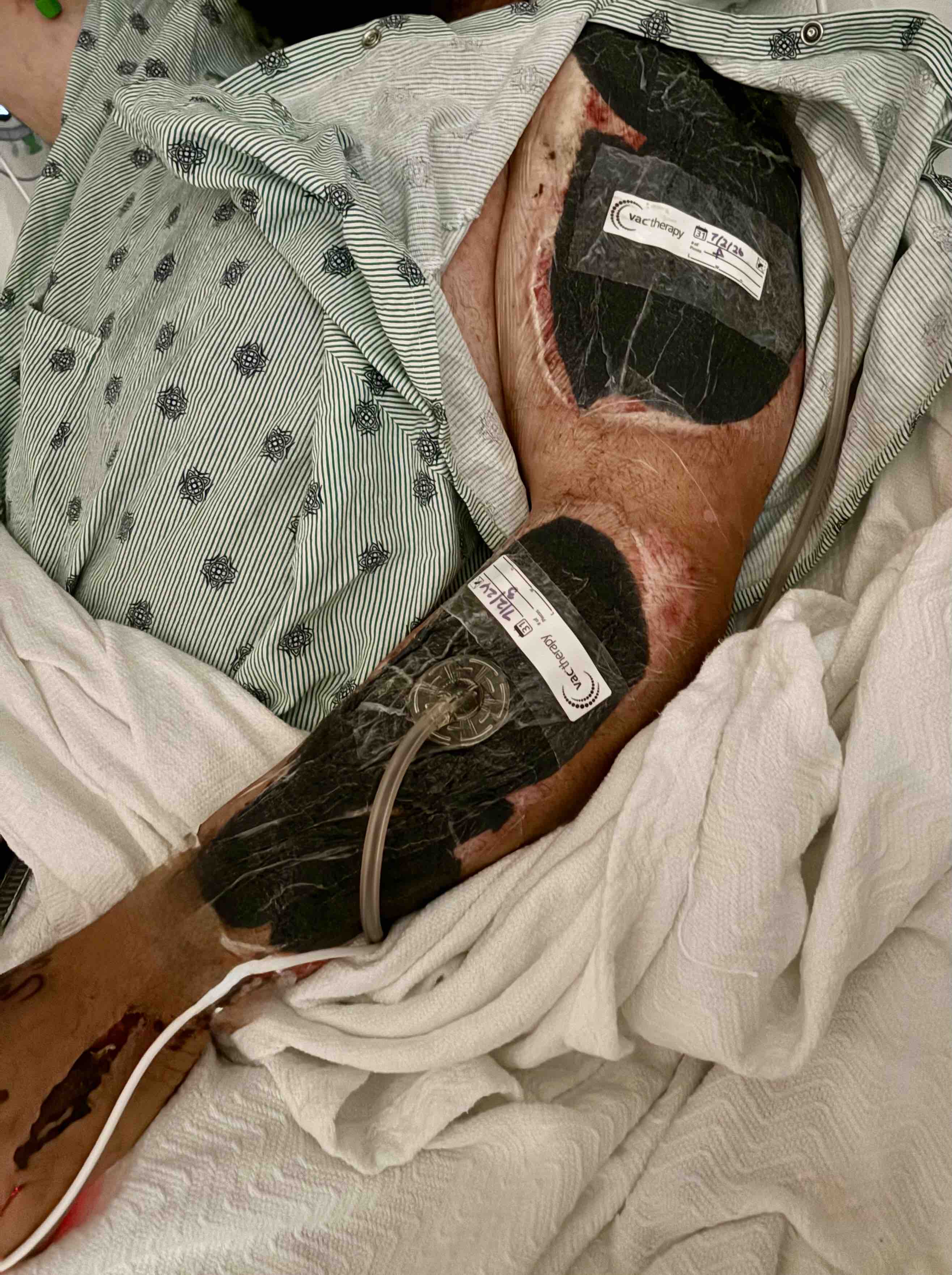 ‼️Victim of 3rd Offense DWI Amputation EMERGENCY FUND ‼️‼️ campaign photo, 2 of 6