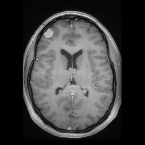 Please Help with Mri expenses due to brain and spine tumors campaign photo, 2 of 8