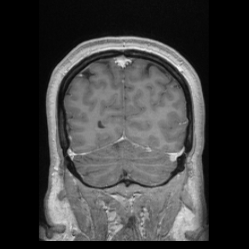 Please Help with Mri expenses due to brain and spine tumors campaign photo, 5 of 8