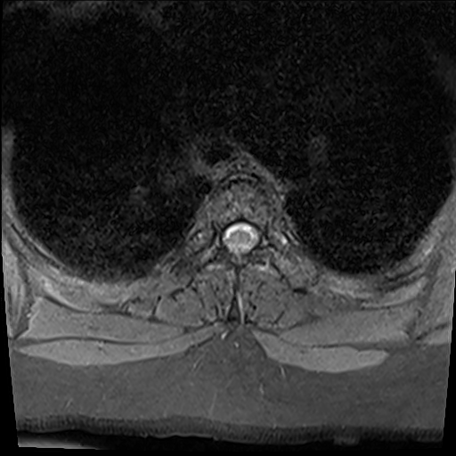 Please Help with Mri expenses due to brain and spine tumors campaign photo, 6 of 8