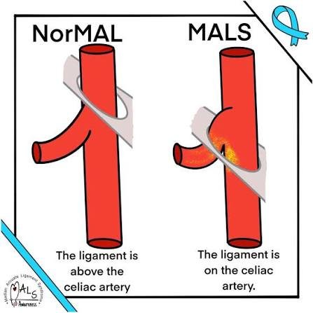 Help Chaos Get Life-Changing MALS Surgery campaign photo, 5 of 6