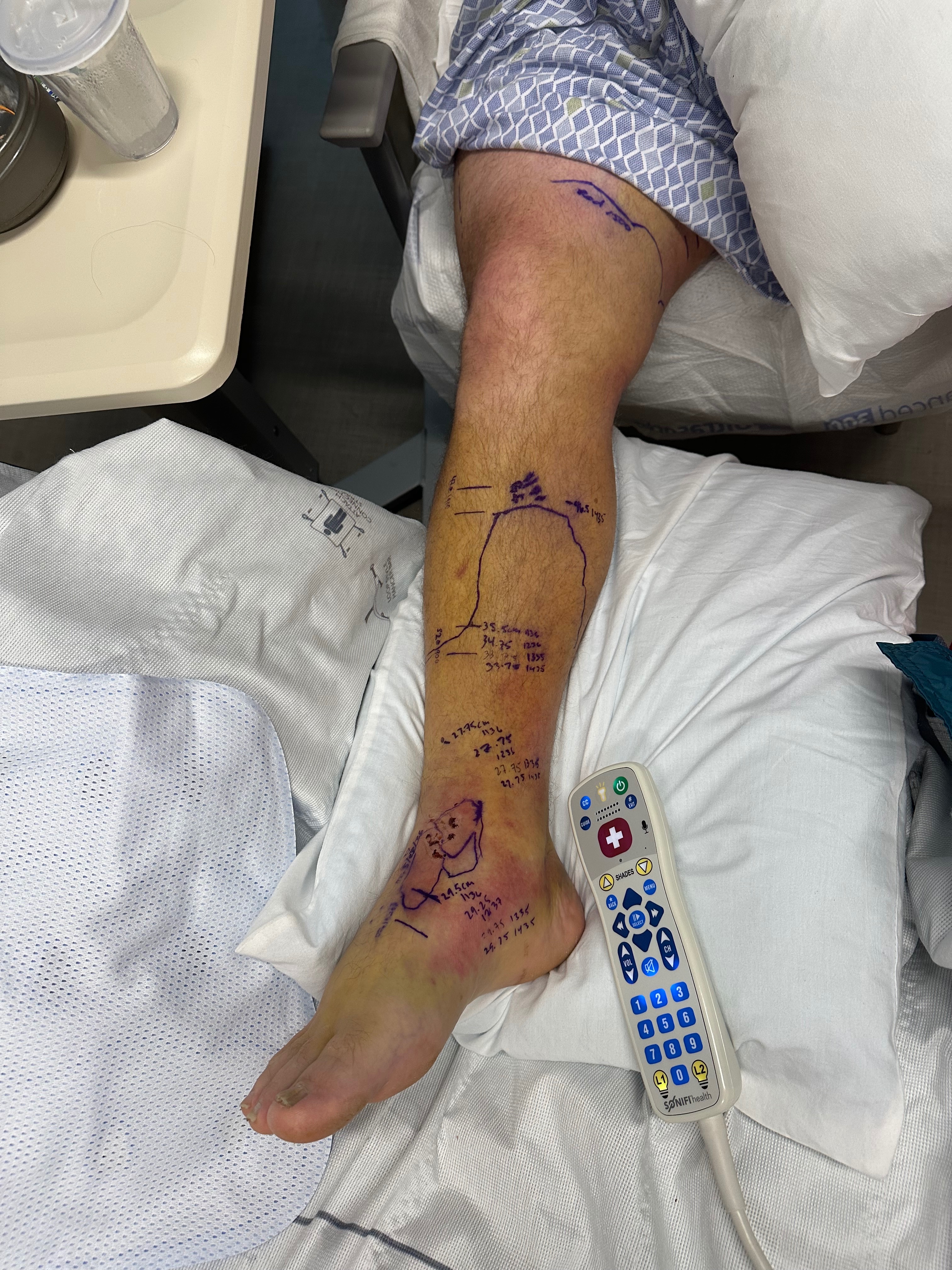 Help Chris Recover from Rattlesnake Bite campaign photo, 5 of 8