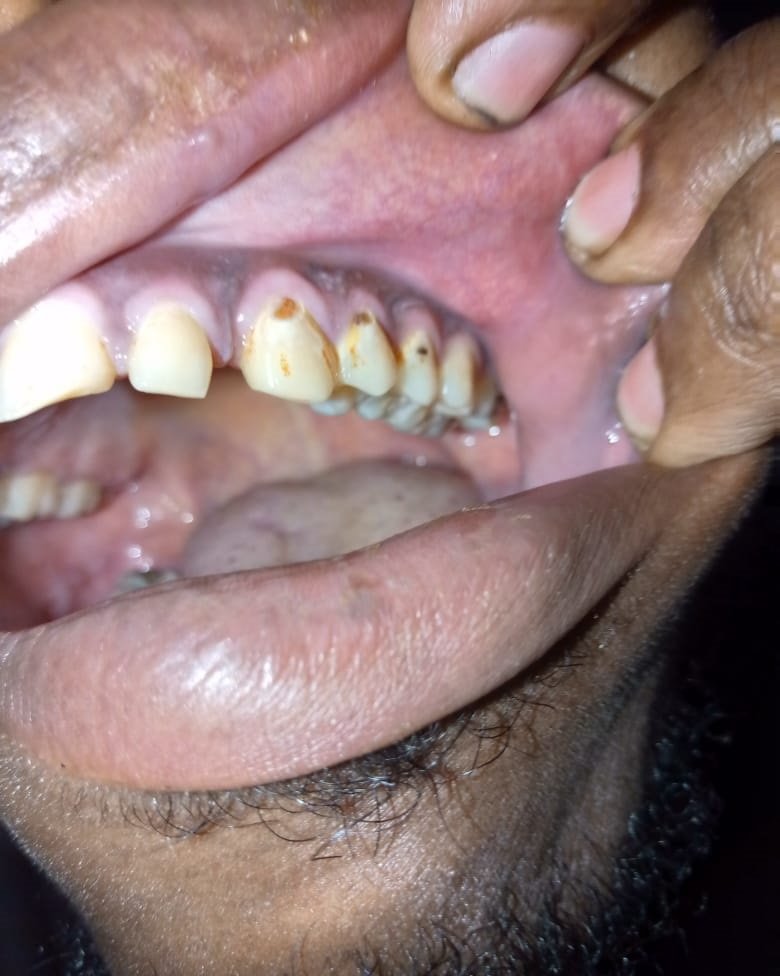 Help Me Restore My Smile, Oral Health, & Relieve Dental pain campaign photo, 2 of 4