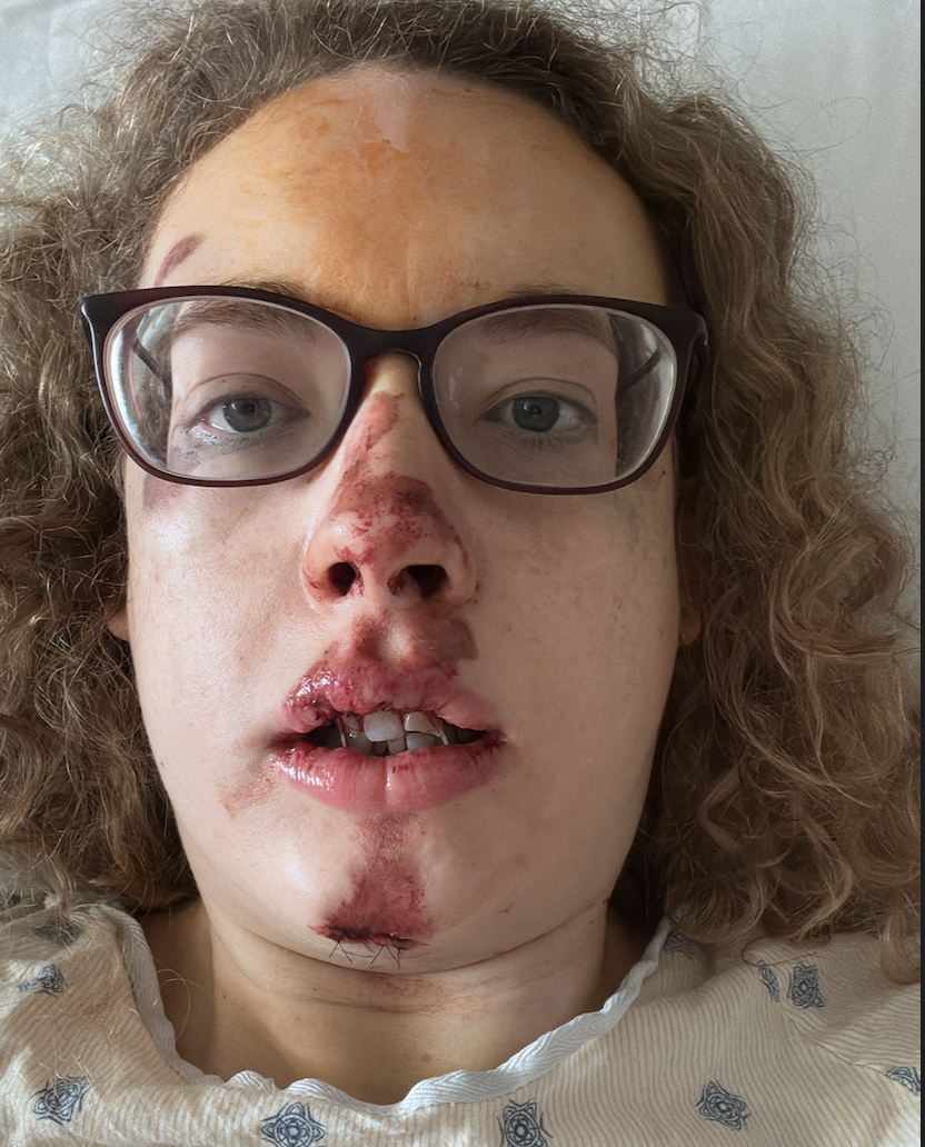 Help Blair Get Her Smile Back After Crash campaign photo, 5 of 8