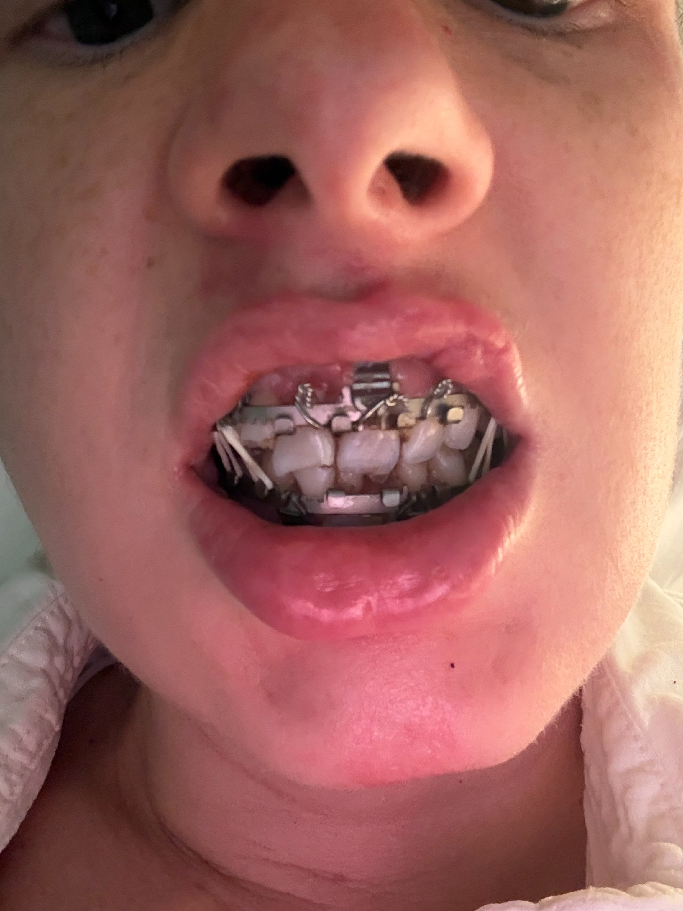 Help Blair Get Her Smile Back After Crash campaign photo, 6 of 8