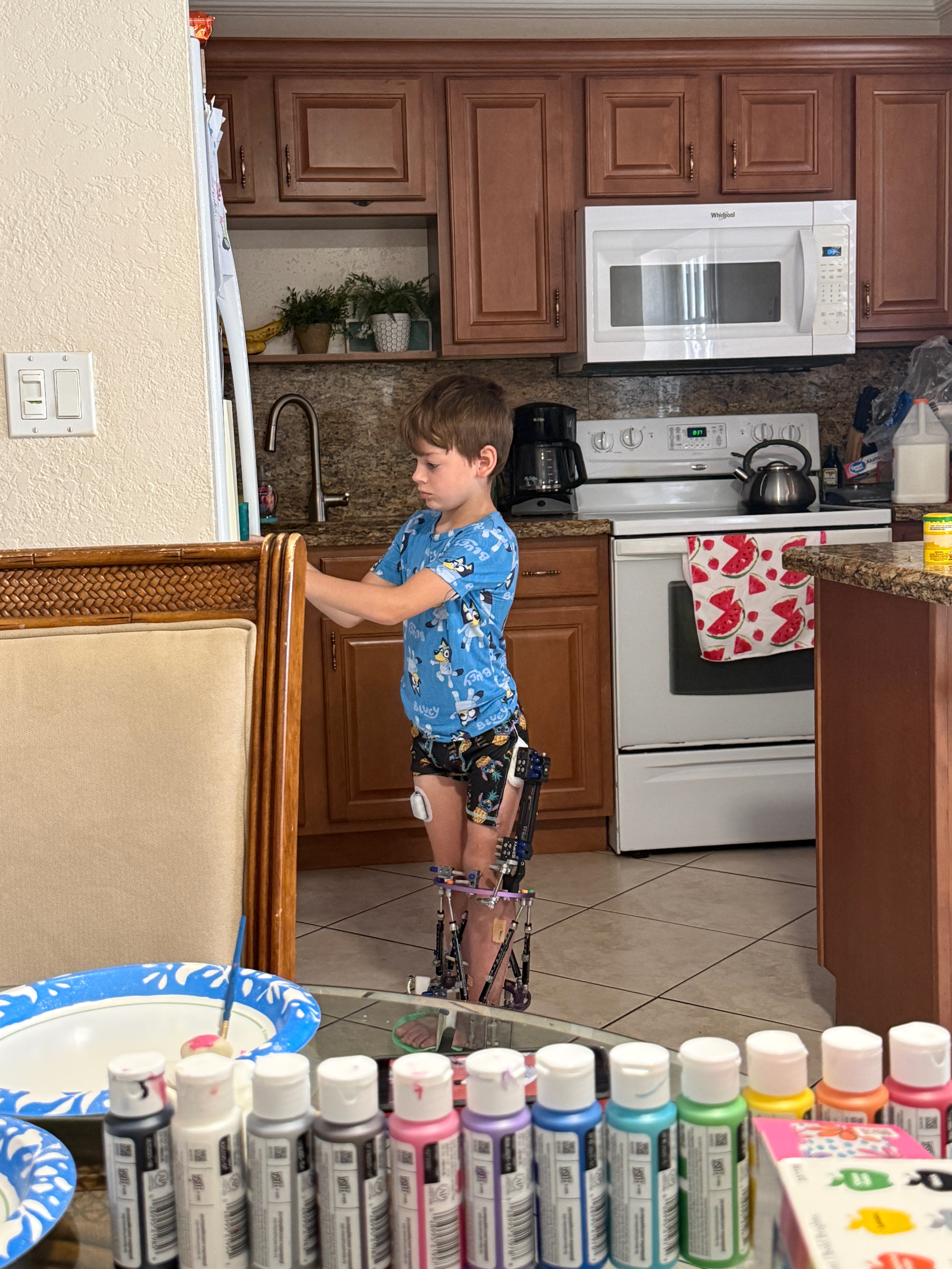 Help Kasen Recover After Leg Surgery campaign photo, 2 of 5