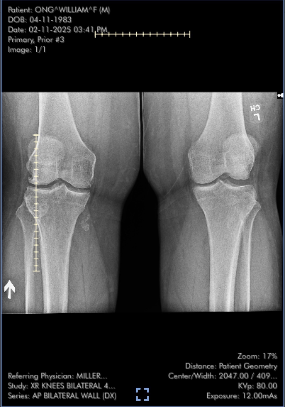 Help Save My Achilles Tendon and My Future campaign photo, 2 of 7