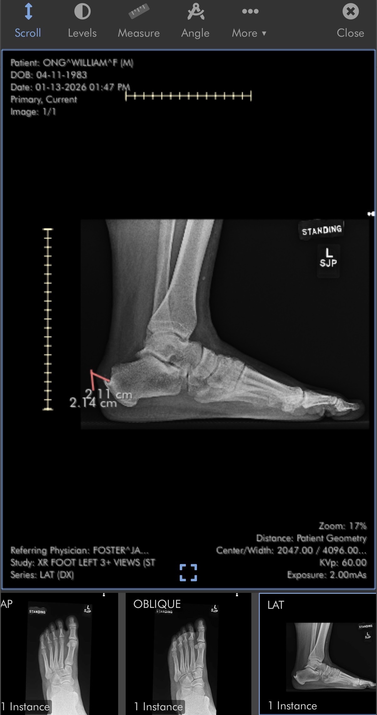 Help Save My Achilles Tendon and My Future campaign photo, 6 of 7