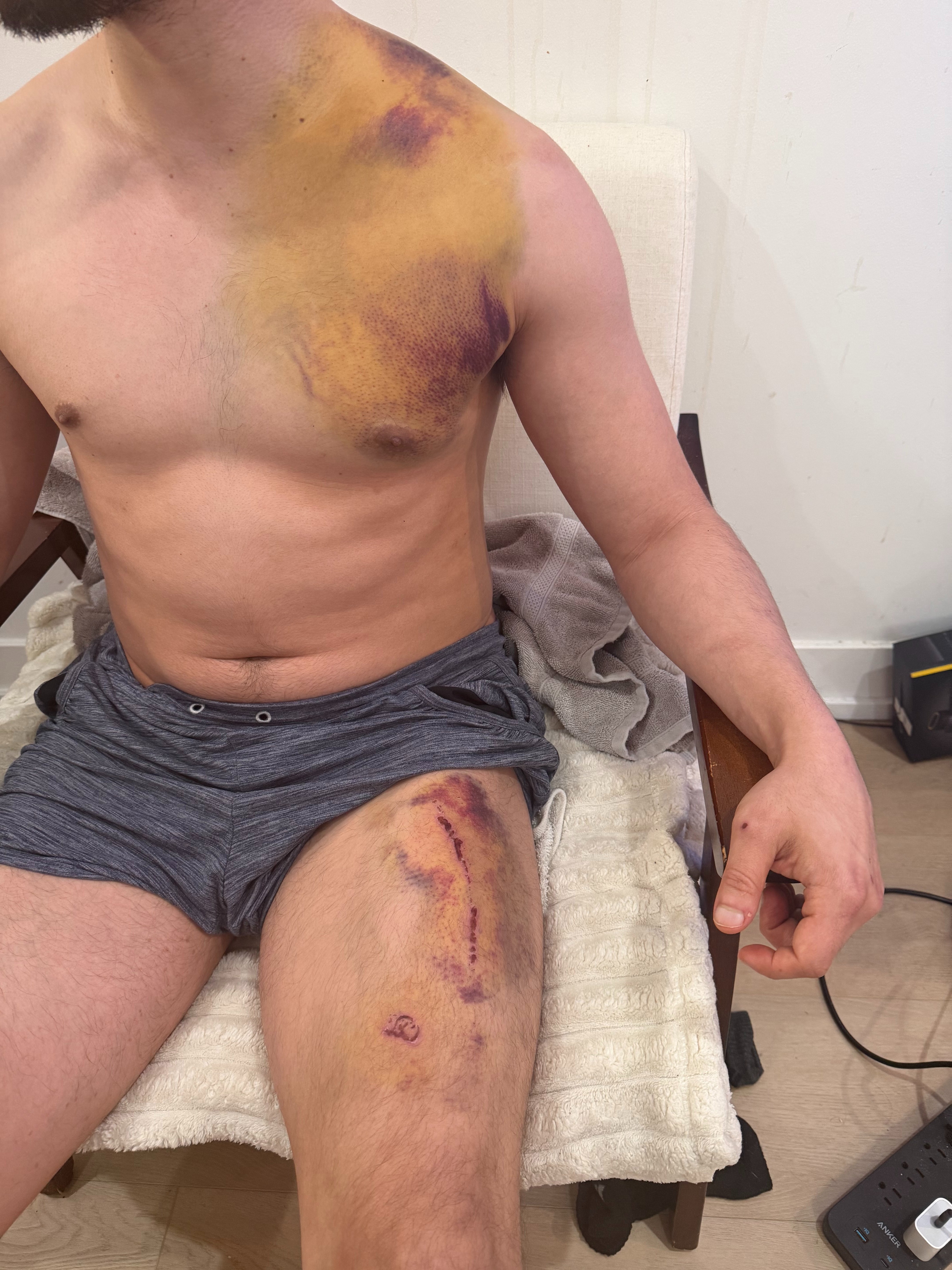 Hit by a Car. Unable to Work. Help Me Keep My Home campaign photo, 4 of 8