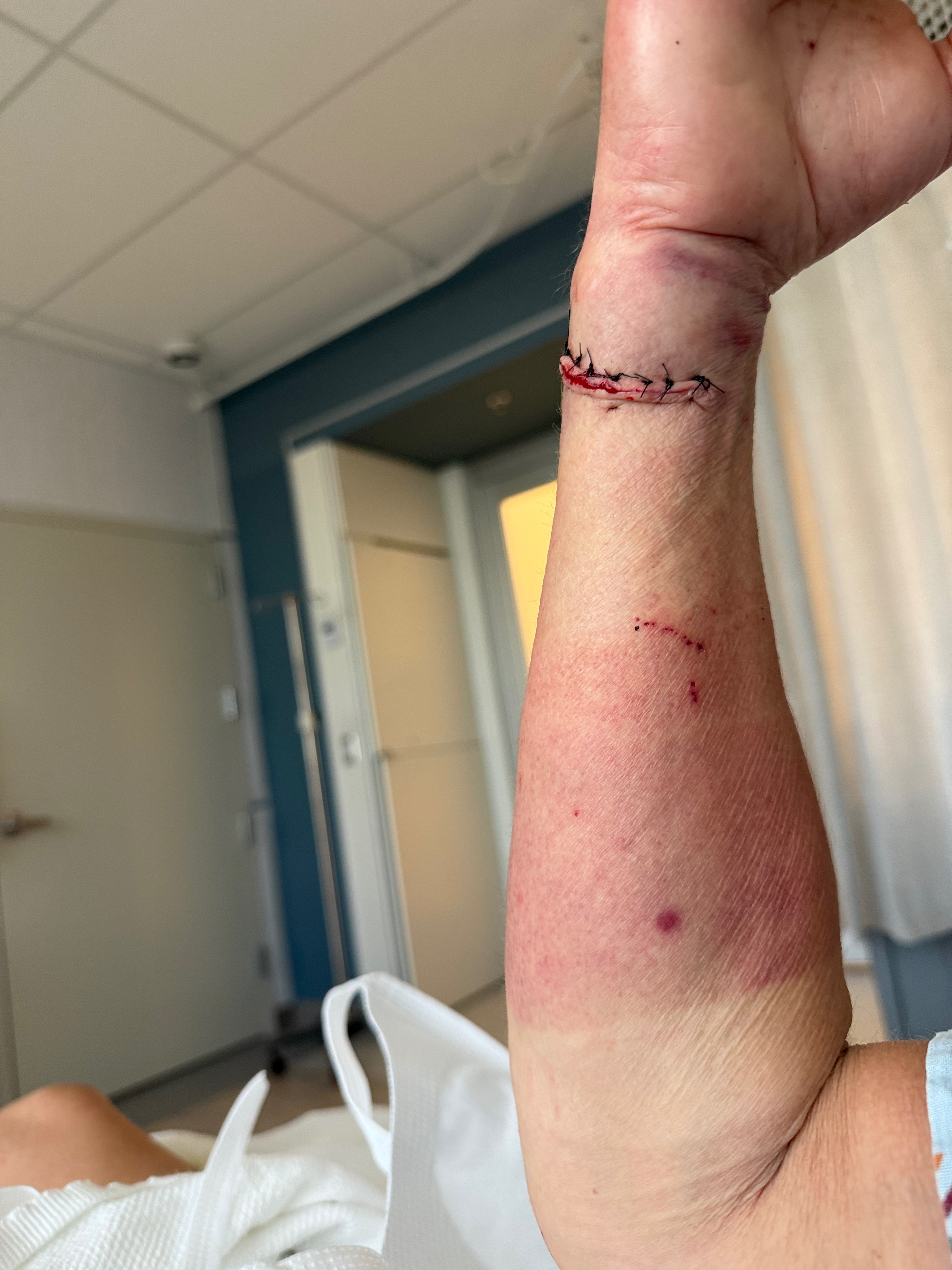 Support Mary’s Recovery After Severe Hand Injury campaign photo, 2 of 6
