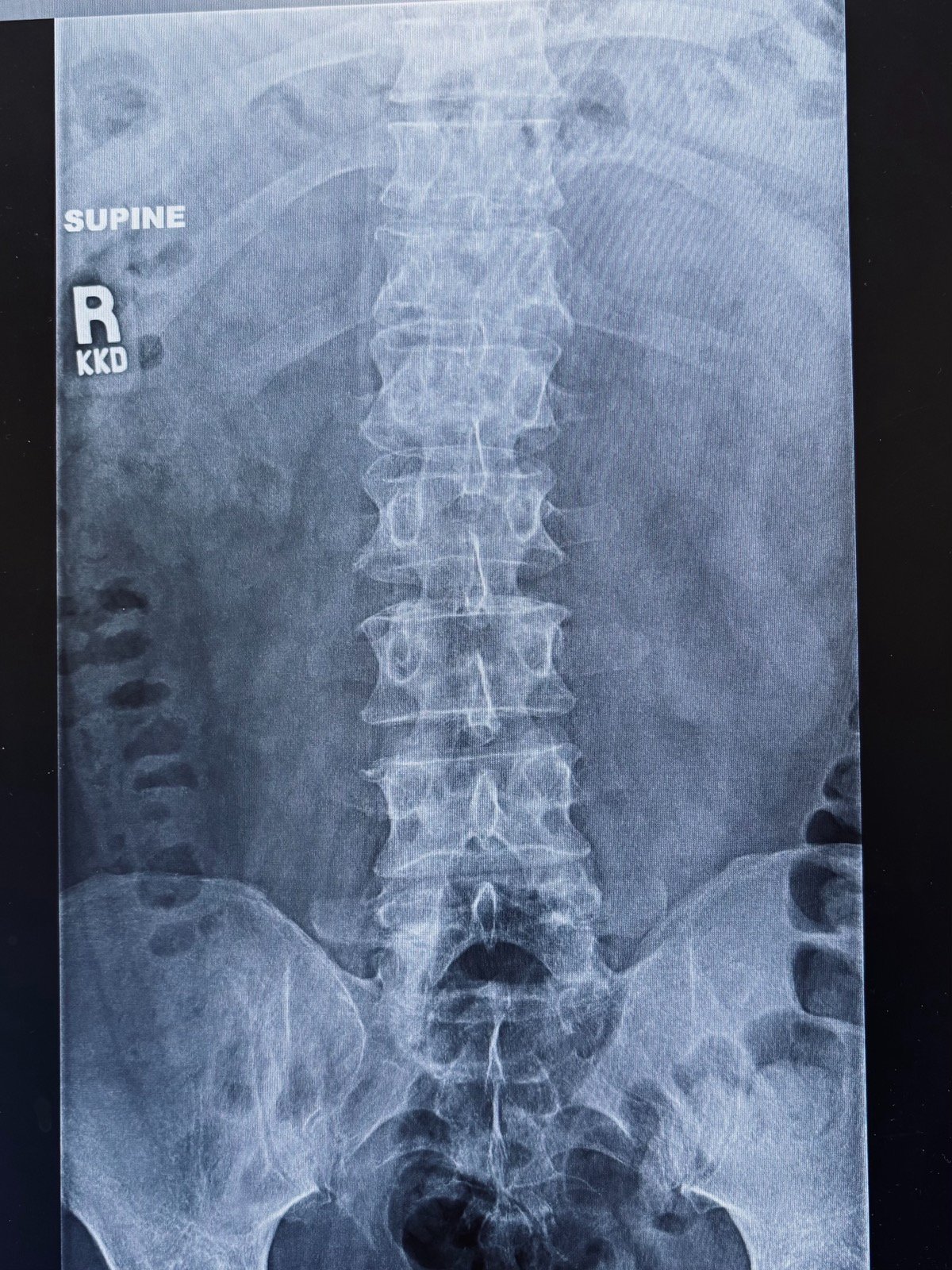 Help Our Friend Kevin Brown Recover From a Fractured Back campaign photo, 2 of 4