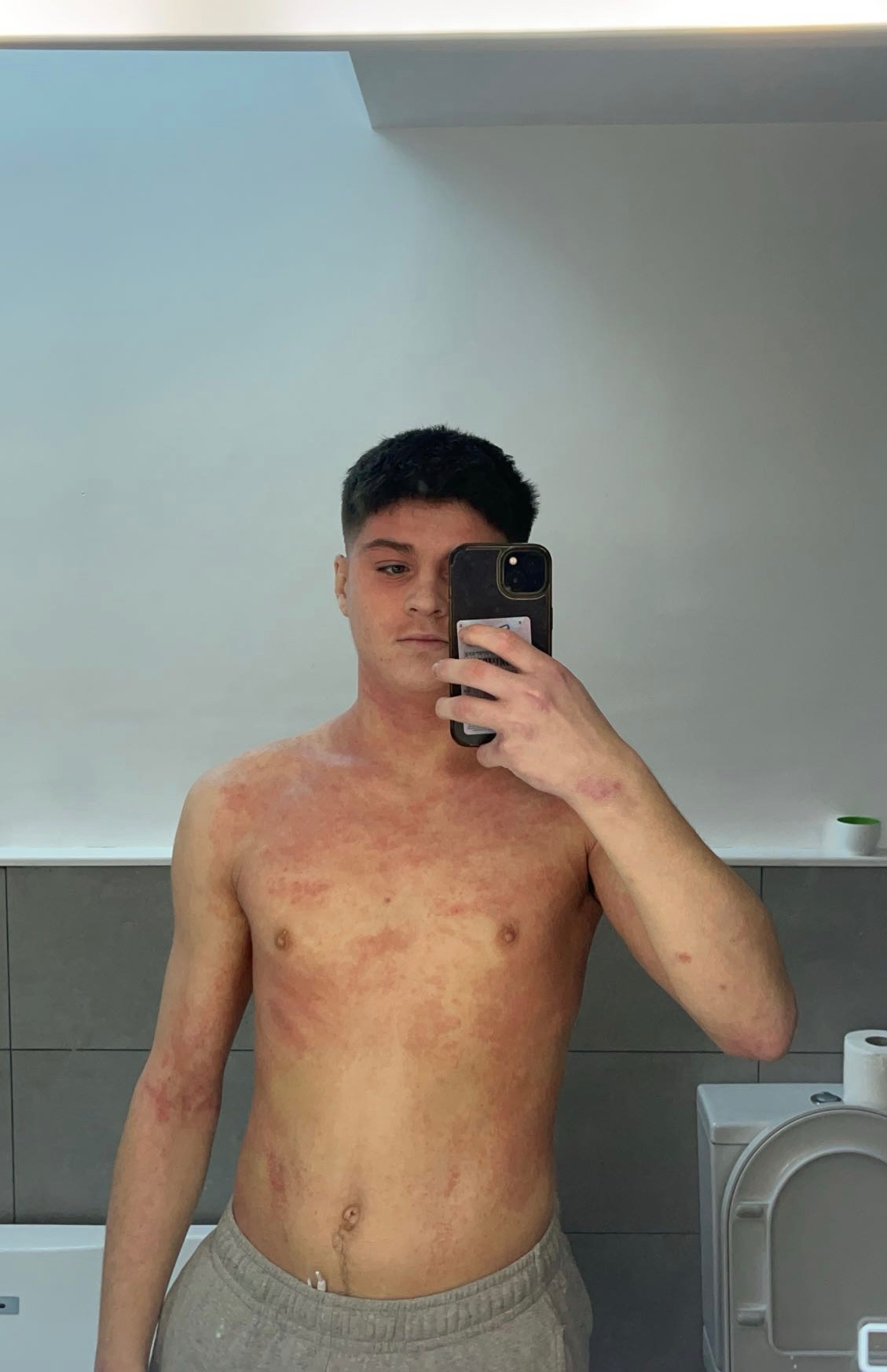 CAP Treatment ar gyfer Topical Steroid Withdrawal (TSW). campaign photo, 5 of 6