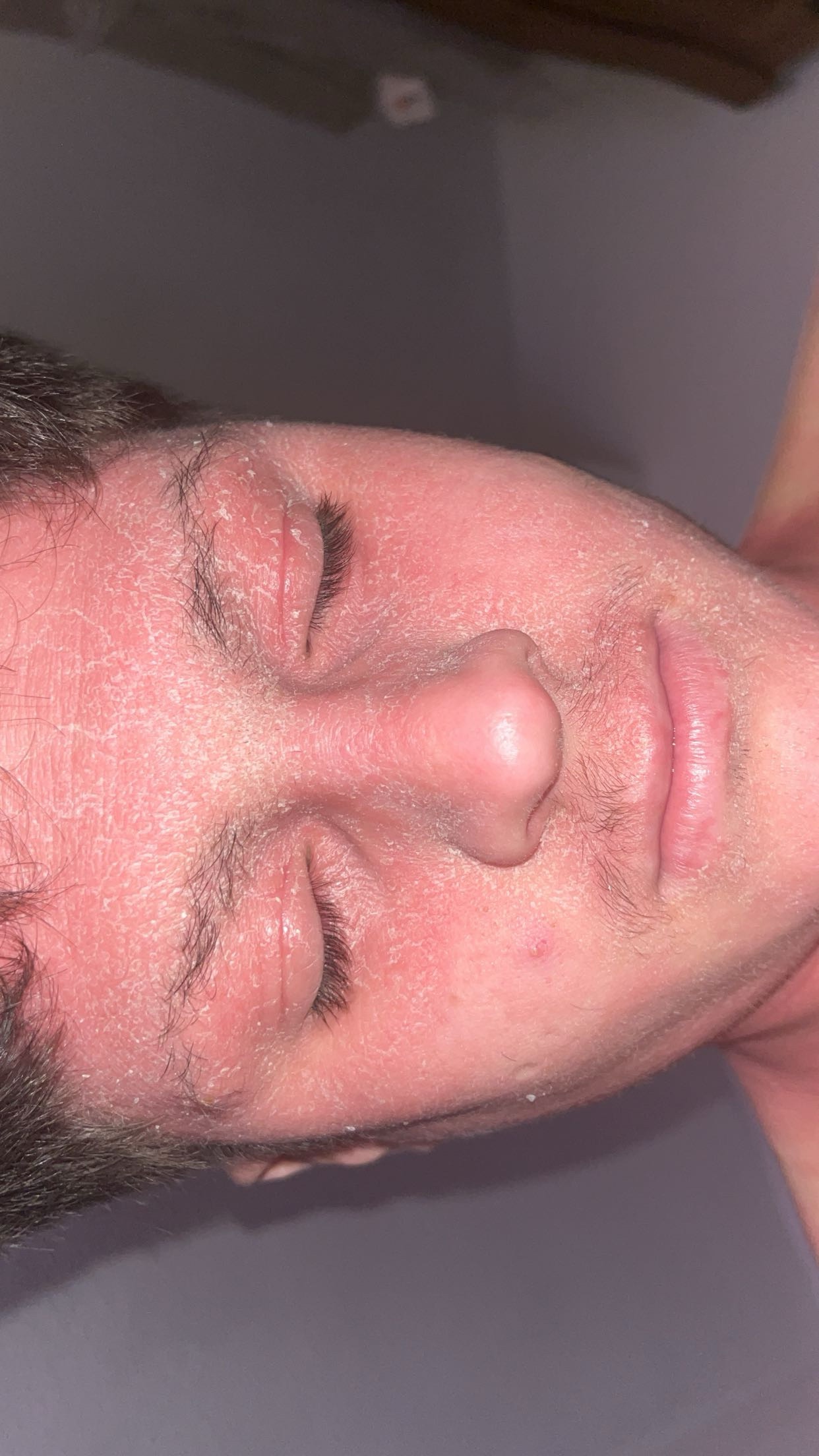 CAP Treatment ar gyfer Topical Steroid Withdrawal (TSW). campaign photo, 4 of 6