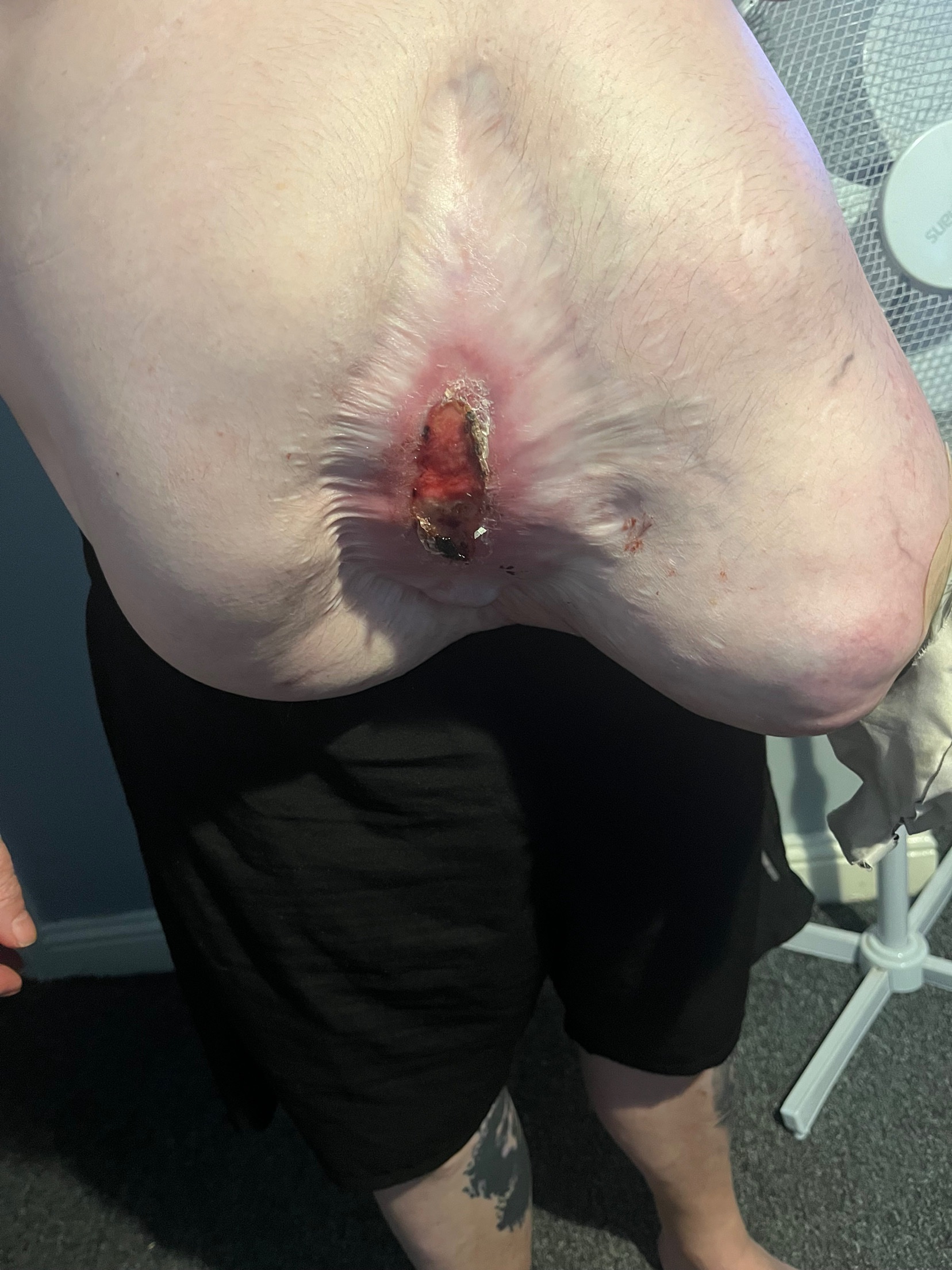 Help raise money for life saving hernia operation campaign photo, 5 of 6