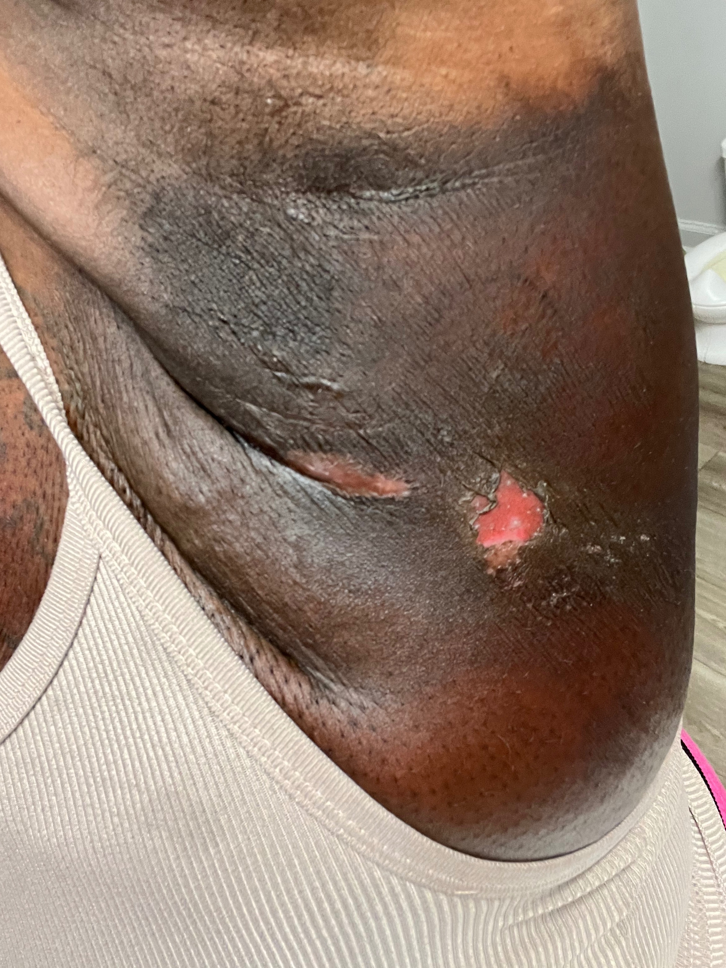 Support Imani’s 12week healing after breast reconstruction campaign photo, 5 of 8