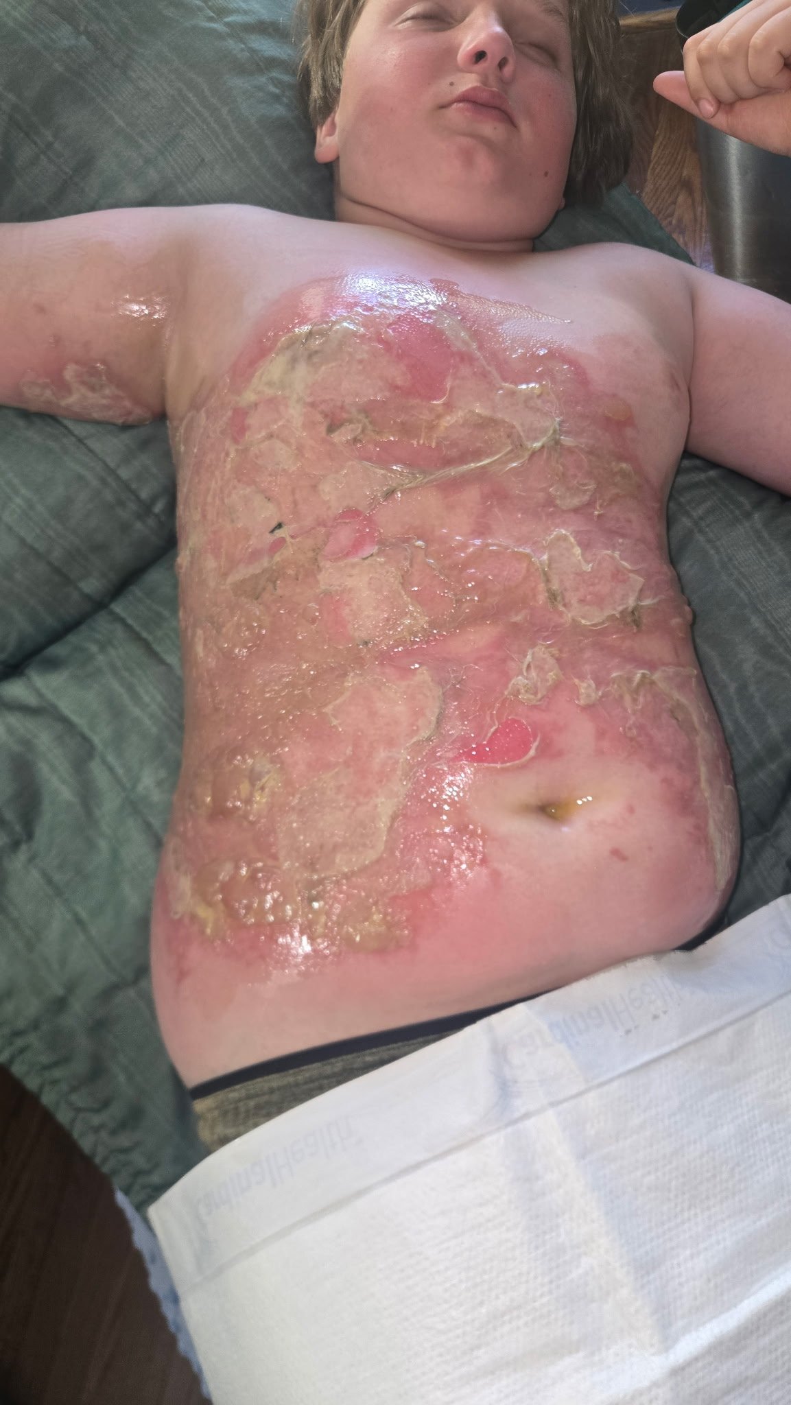 Support for 10-Year-Old Burn Survivor campaign photo, 2 of 5