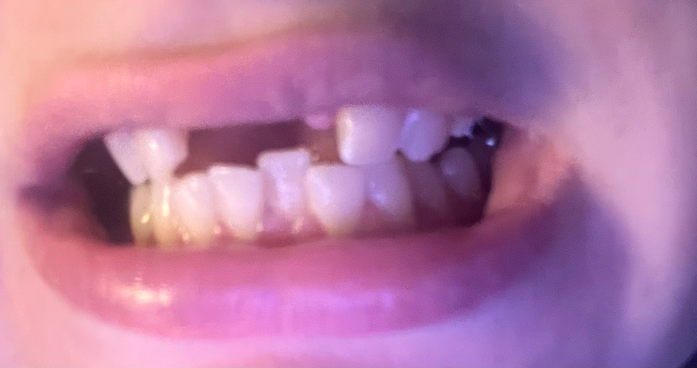 Help Restore My Smile After Accident campaign photo, 2 of 6