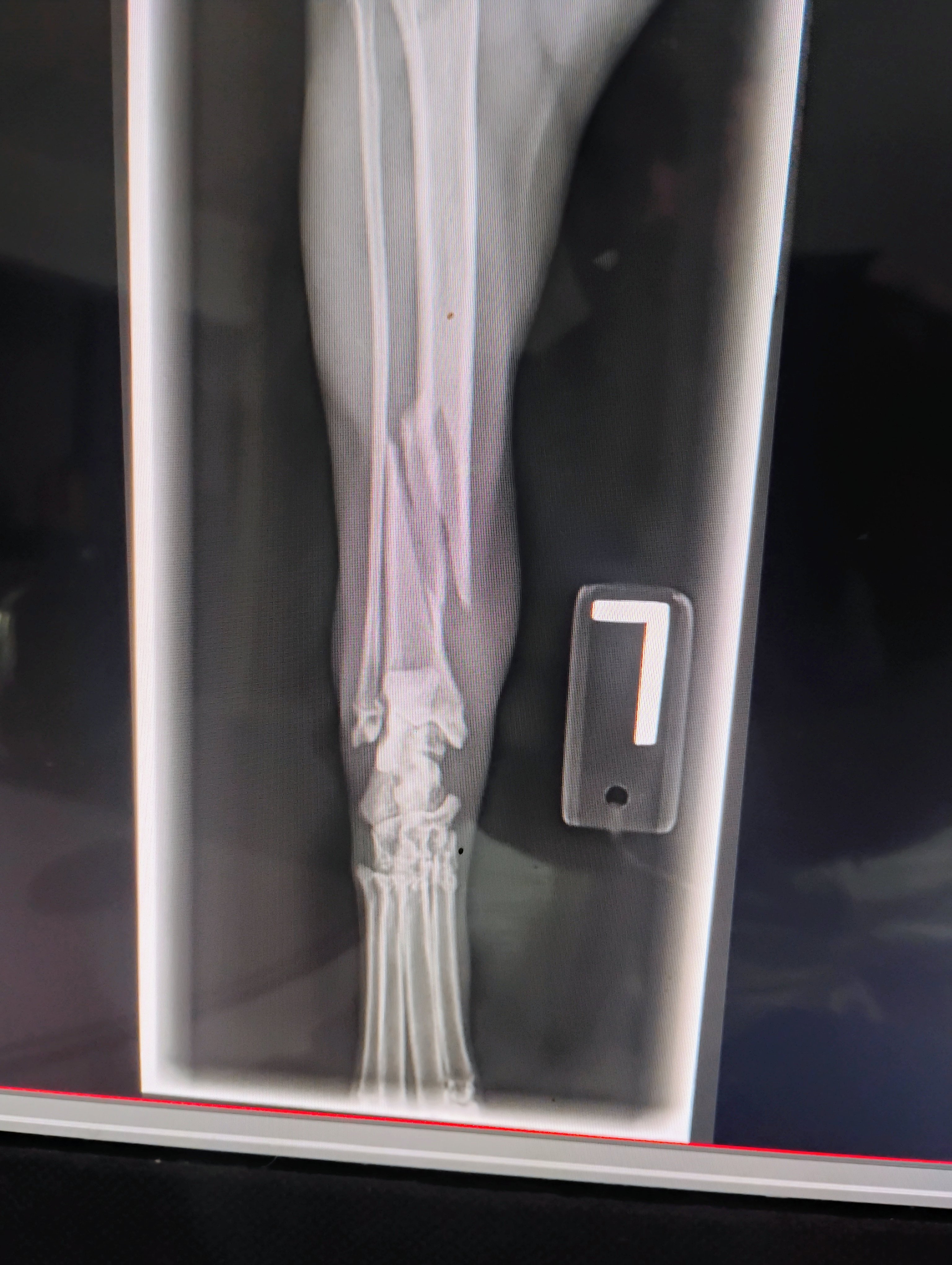 Cover costs for Ivy's Spiral Tibia Fracture Surgery campaign photo, 4 of 5
