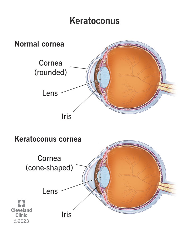 Help Francis Save His Eyesight with Surgery campaign photo, 4 of 5