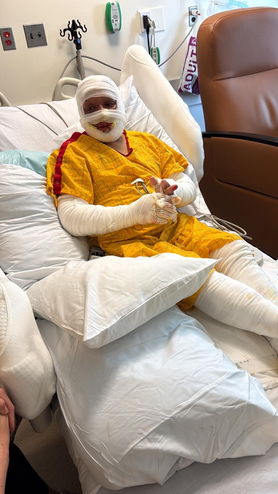Support Fabian’s Recovery After the Fire campaign photo, 4 of 5