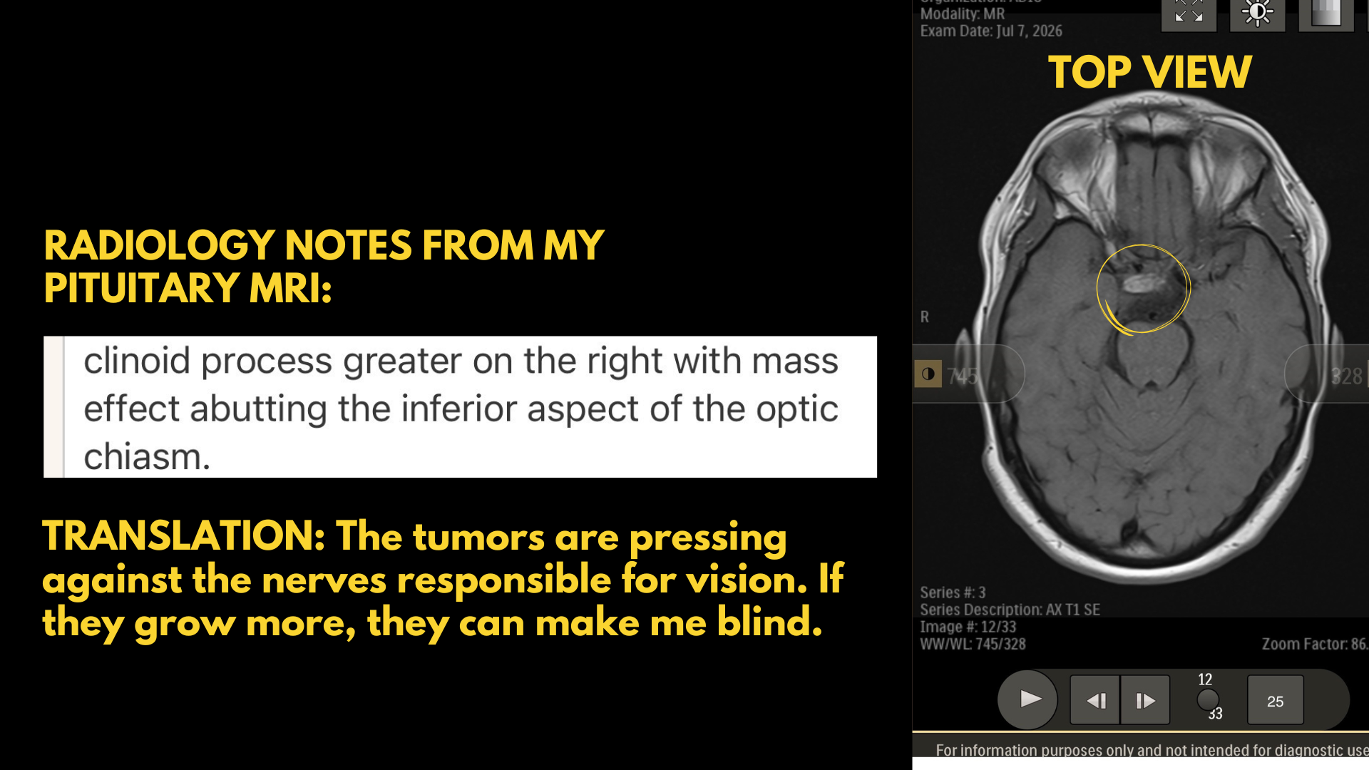 Help Samantha Access Specialized Skull Base Tumor Care campaign photo, 4 of 8