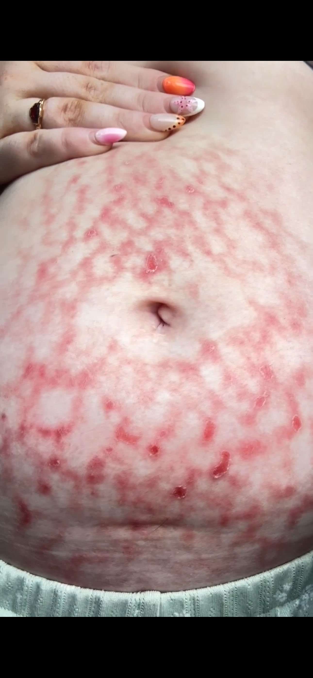 Urgent Endometriosis Surgery Fund Danielle’s Story campaign photo, 5 of 8