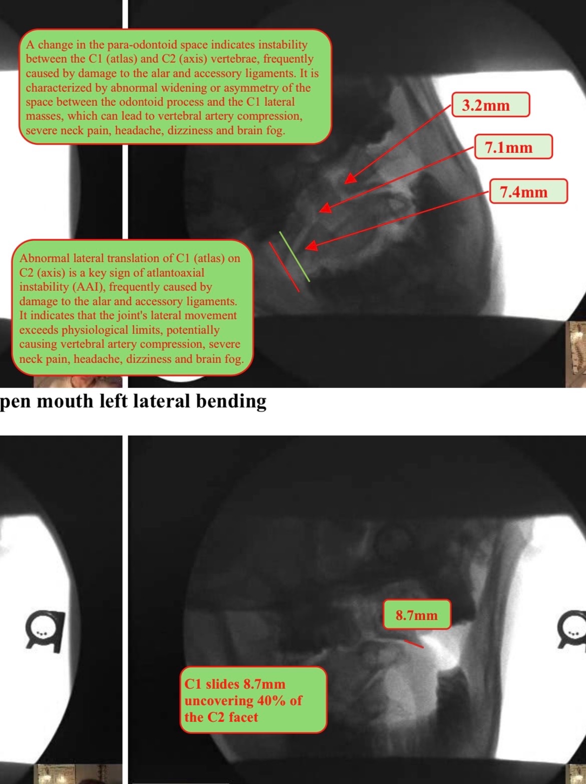 Help Ry Fix Her Spine with PICL procedure campaign photo, 2 of 6